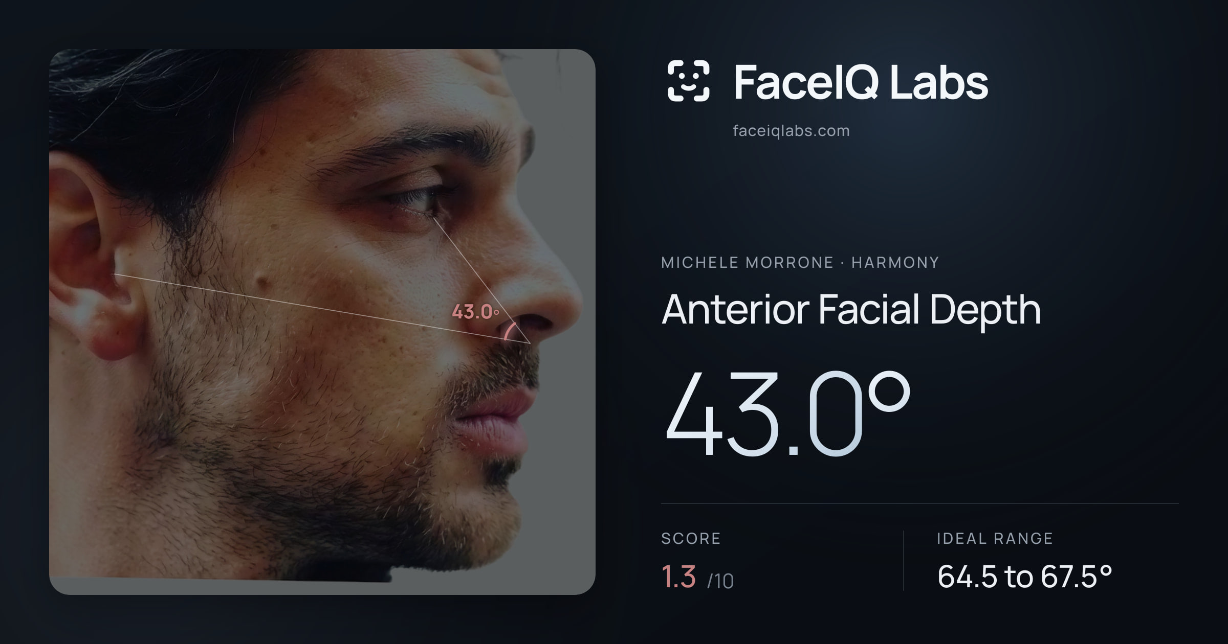 Michele Morrone Anterior Facial Depth: 43.0°, drawn on the photo