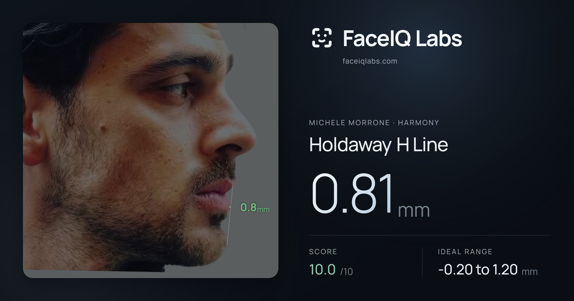 Michele Morrone Holdaway H Line: 0.81mm, drawn on the photo