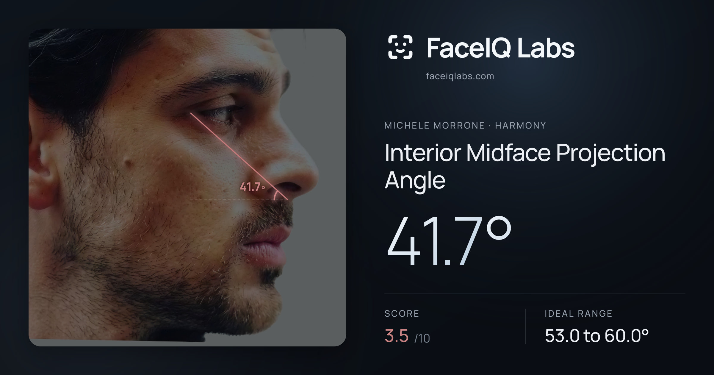 Michele Morrone Interior Midface Projection Angle: 41.7°, drawn on the photo