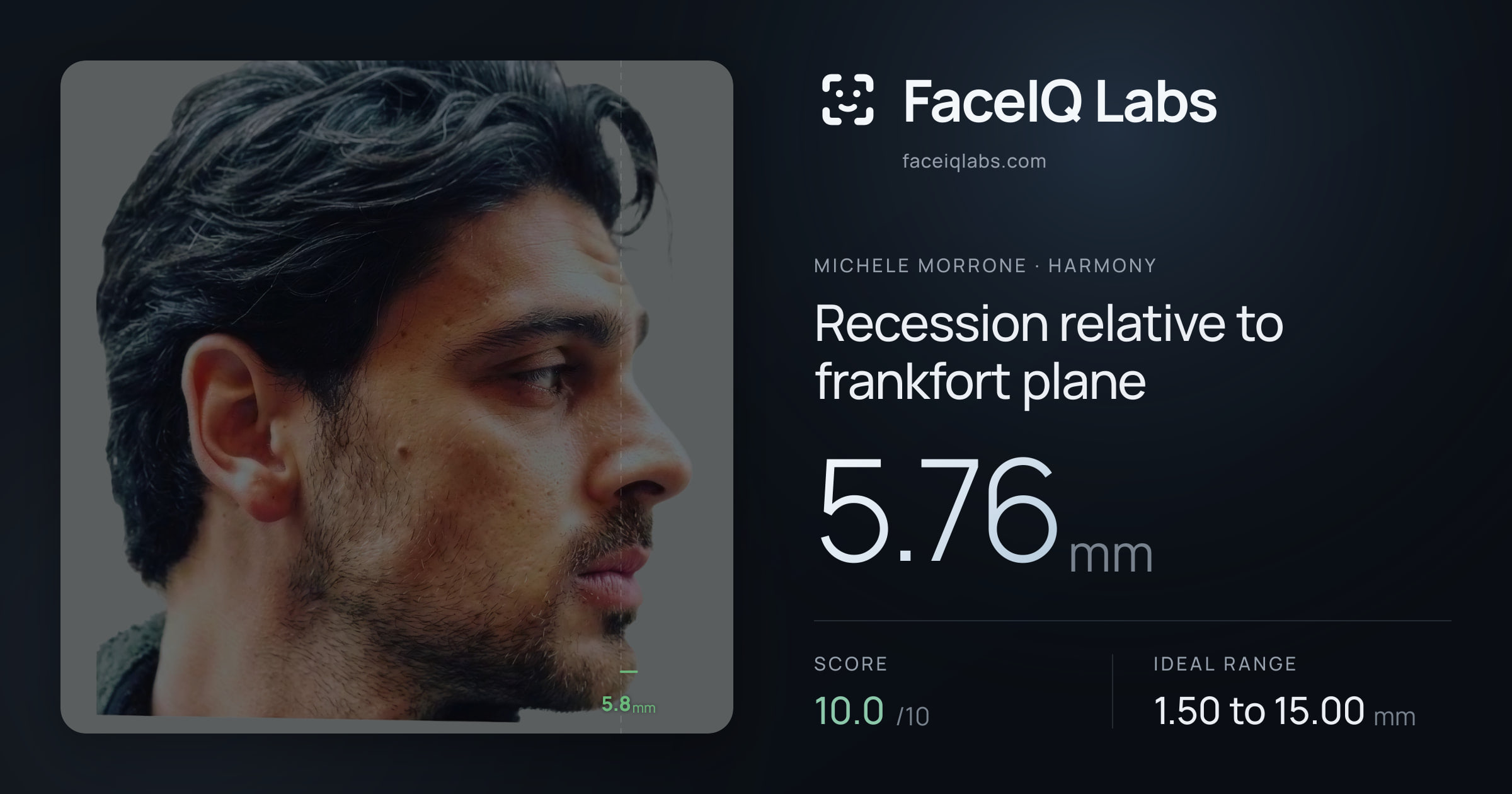 Michele Morrone Recession relative to frankfort plane: 5.76mm, drawn on the photo