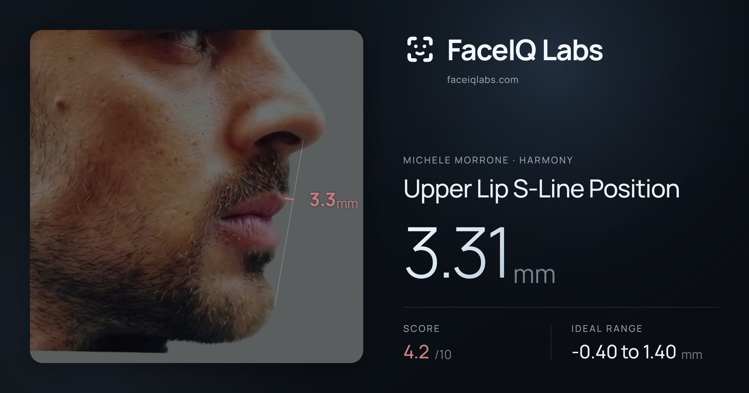 Michele Morrone Upper Lip S-Line Position: 3.31mm, drawn on the photo