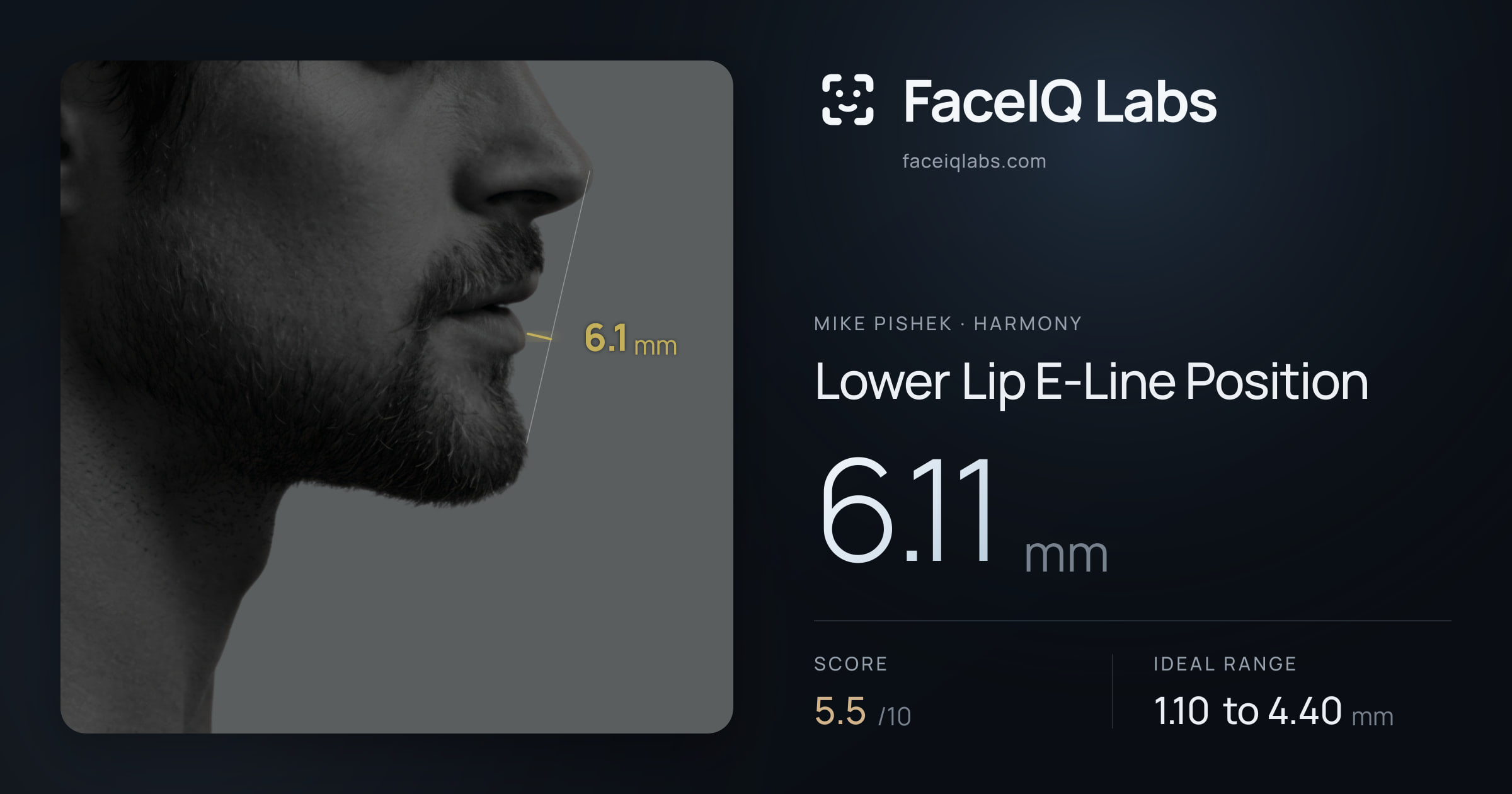 Mike Pishek Lower Lip E-Line Position: 6.11mm, drawn on the photo