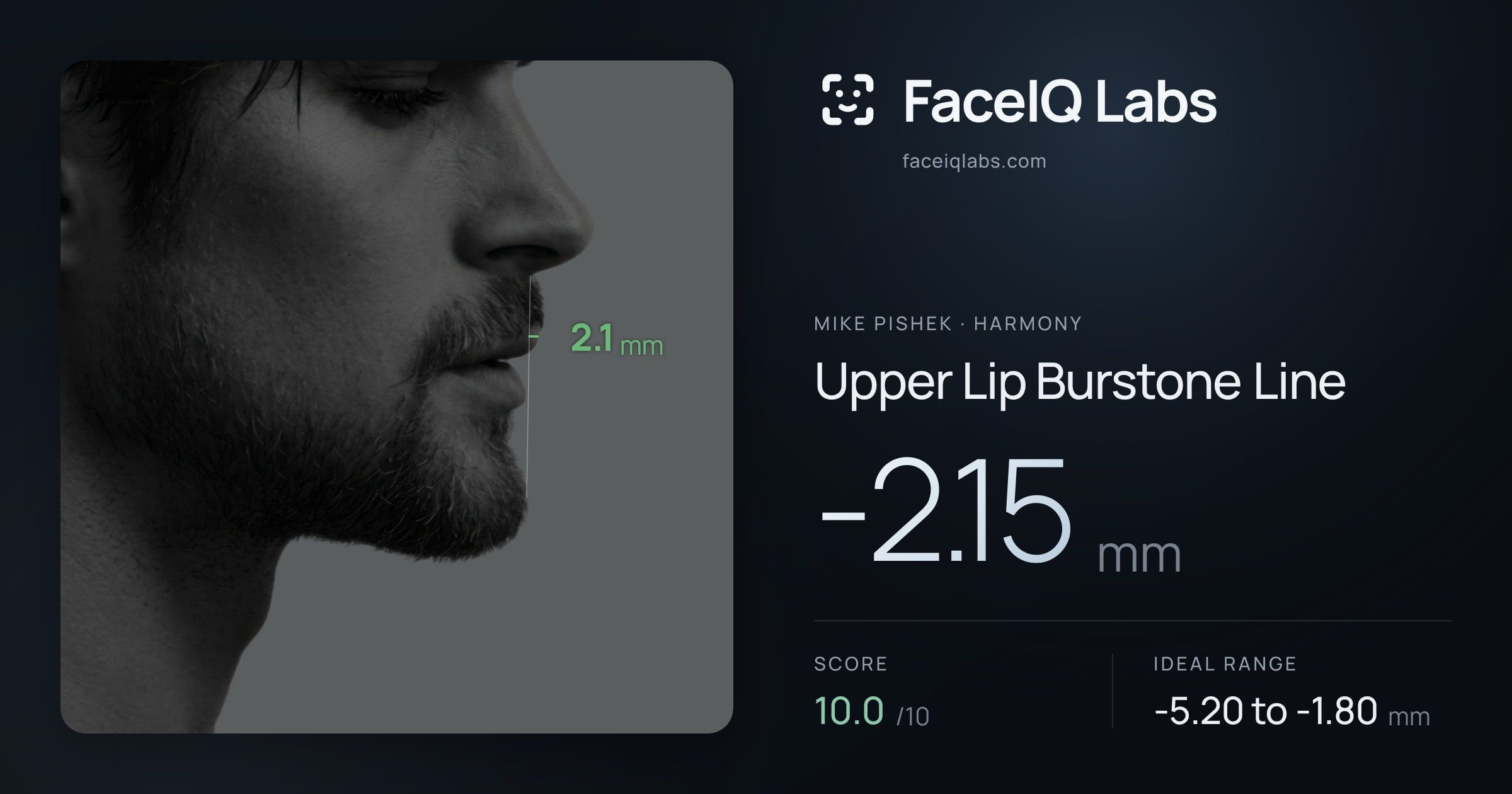 Mike Pishek Upper Lip Burstone Line: -2.15mm, drawn on the photo