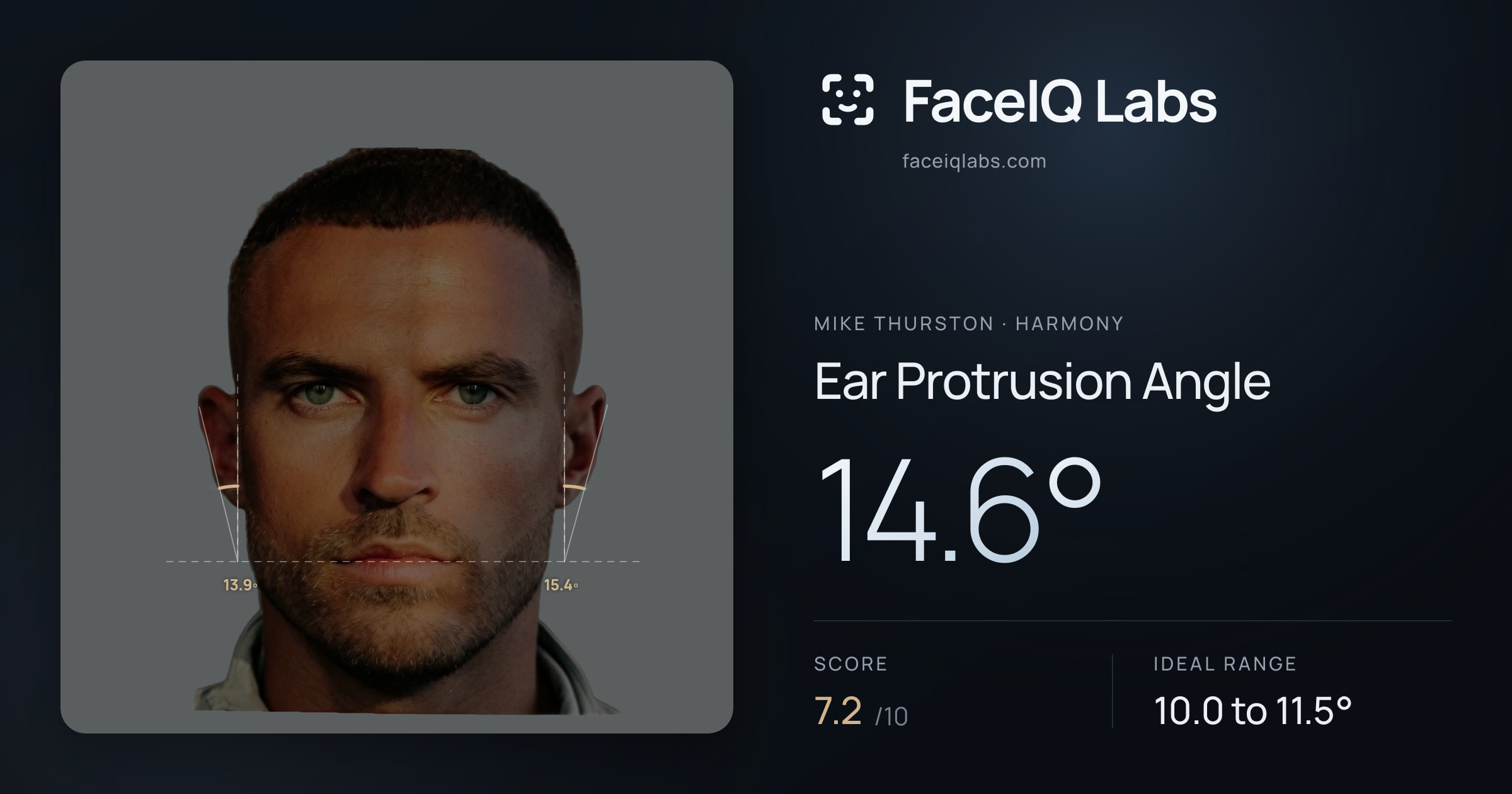 Mike Thurston Ear Protrusion Angle: 14.6°, drawn on the photo