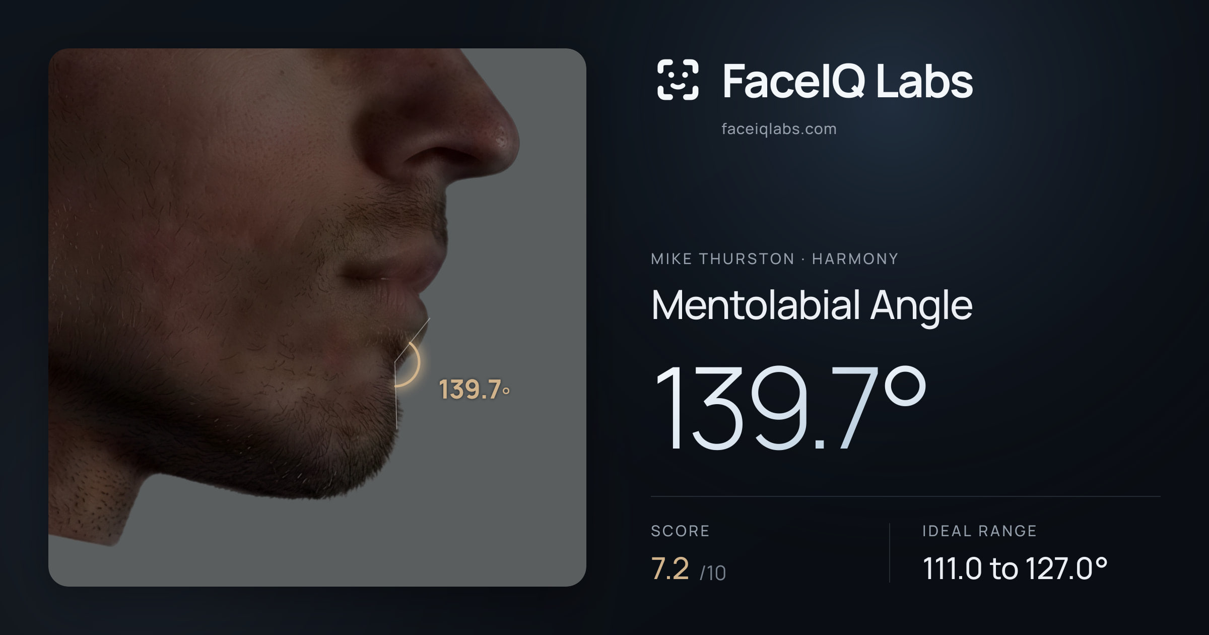 Mike Thurston Mentolabial Angle: 139.7°, drawn on the photo