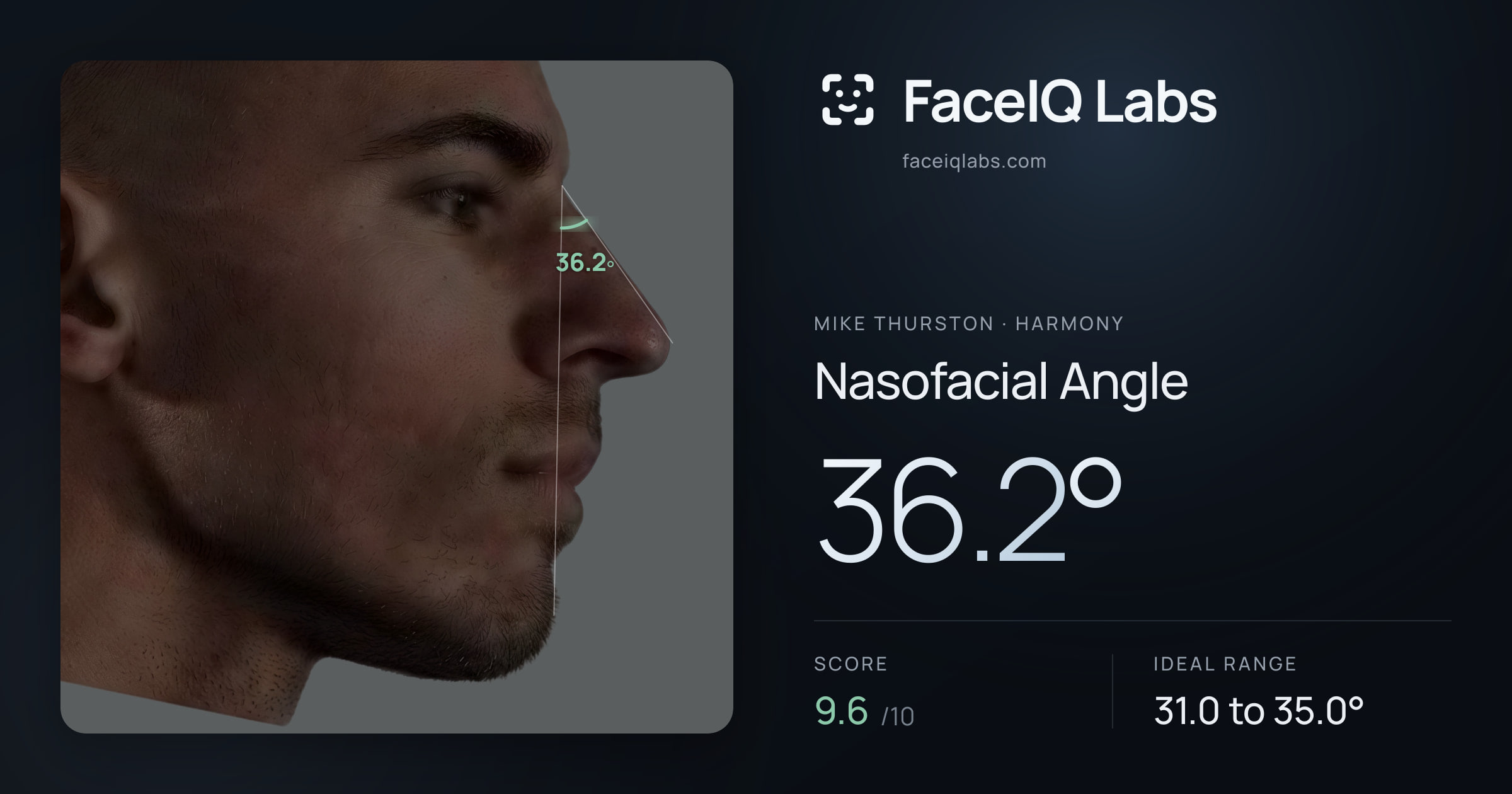 Mike Thurston Nasofacial Angle: 36.2°, drawn on the photo