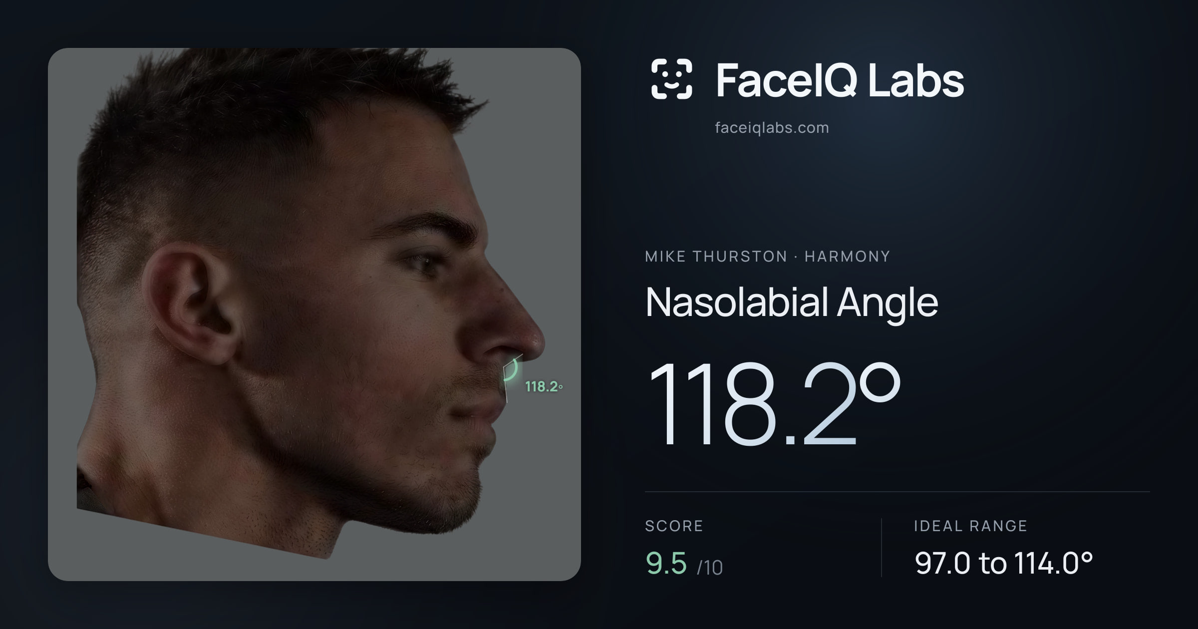 Mike Thurston Nasolabial Angle: 118.2°, drawn on the photo