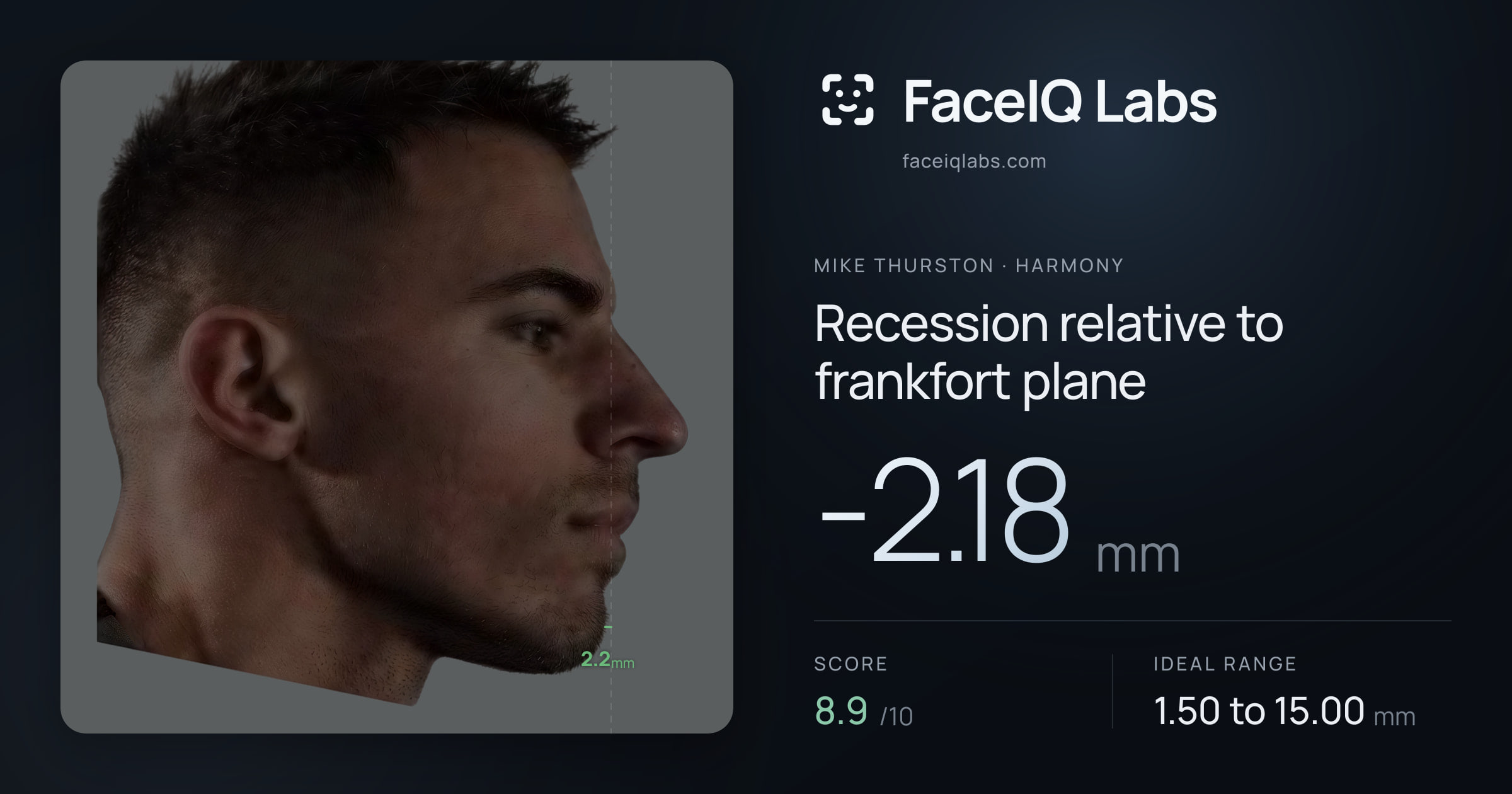 Mike Thurston Recession relative to frankfort plane: -2.18mm, drawn on the photo
