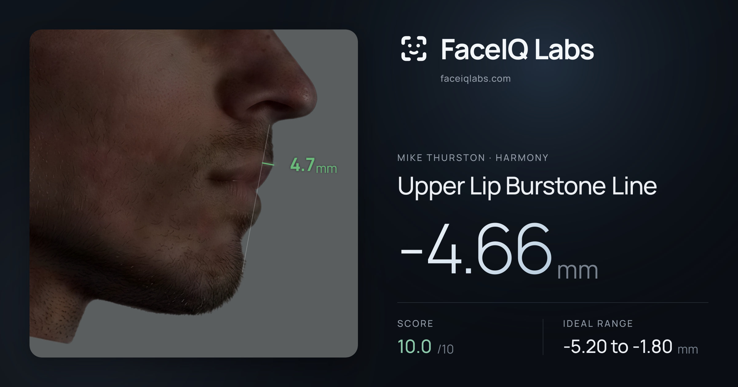 Mike Thurston Upper Lip Burstone Line: -4.66mm, drawn on the photo