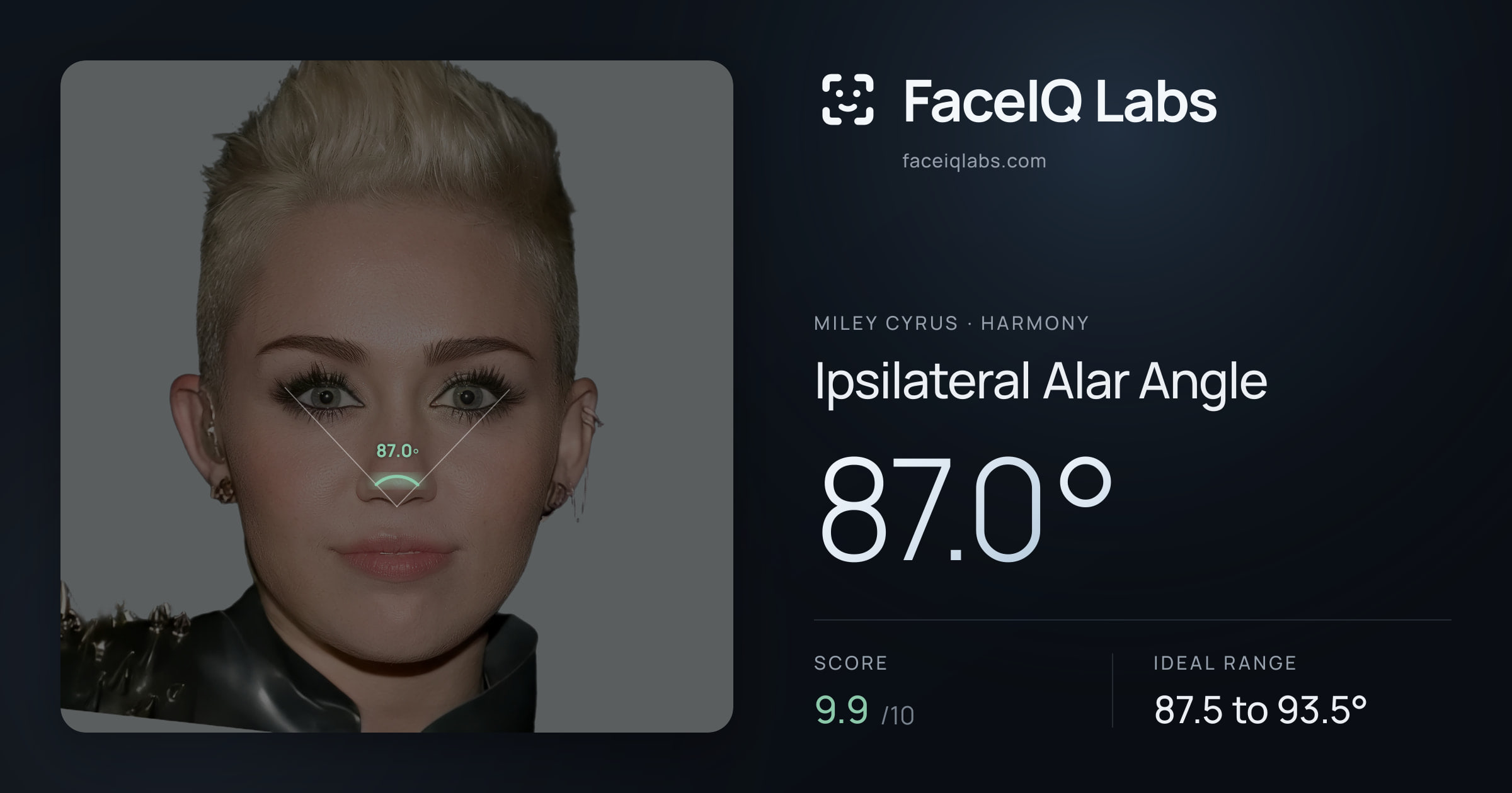 Miley Cyrus Ipsilateral Alar Angle: 87.0°, drawn on the photo