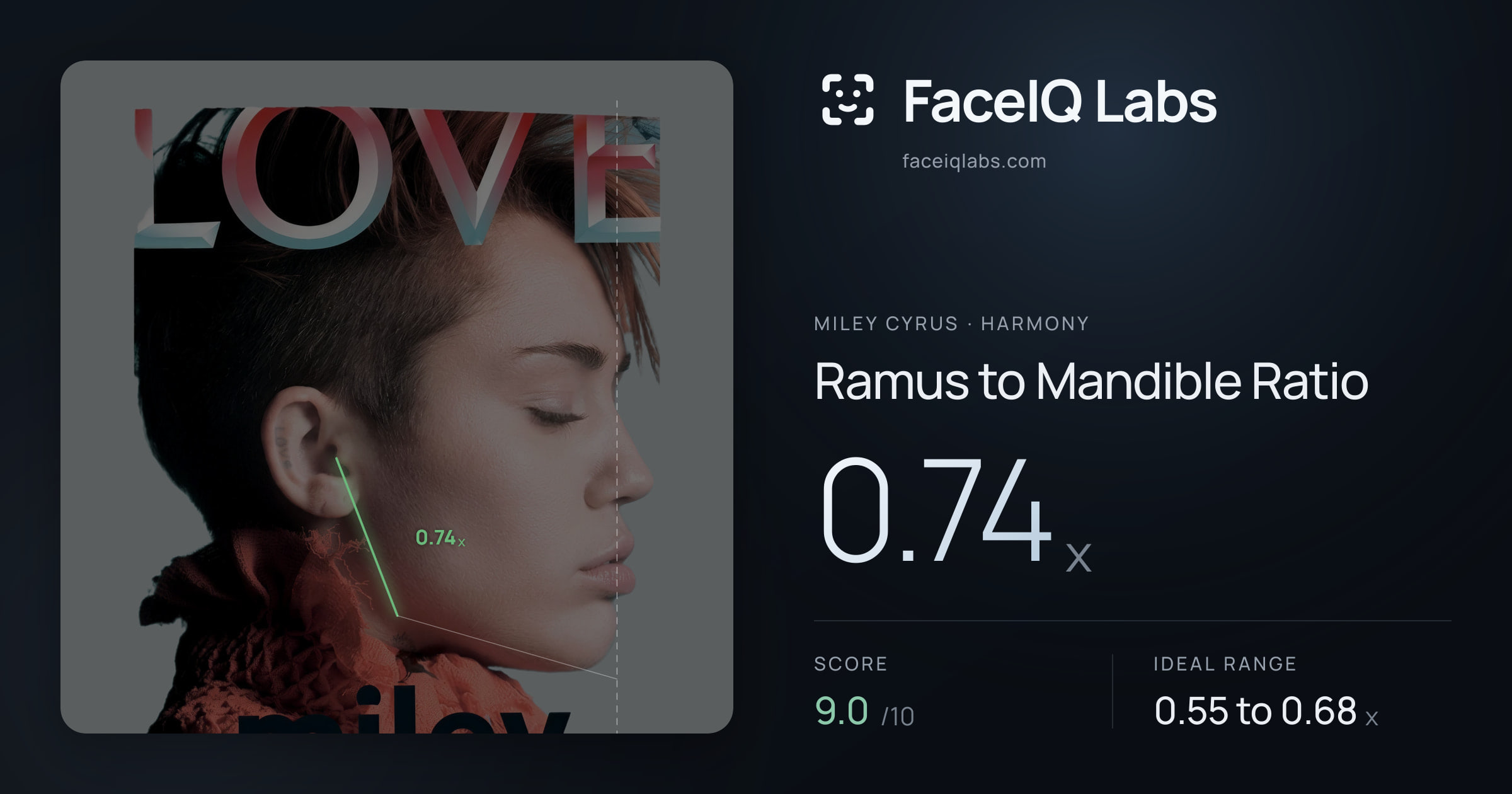 Miley Cyrus Ramus to Mandible Ratio: 0.74x, drawn on the photo