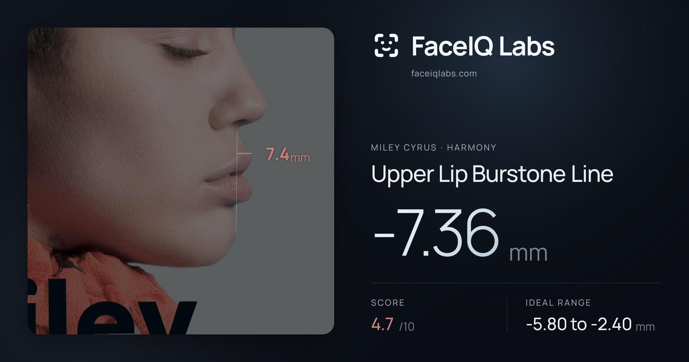 Miley Cyrus Upper Lip Burstone Line: -7.36mm, drawn on the photo