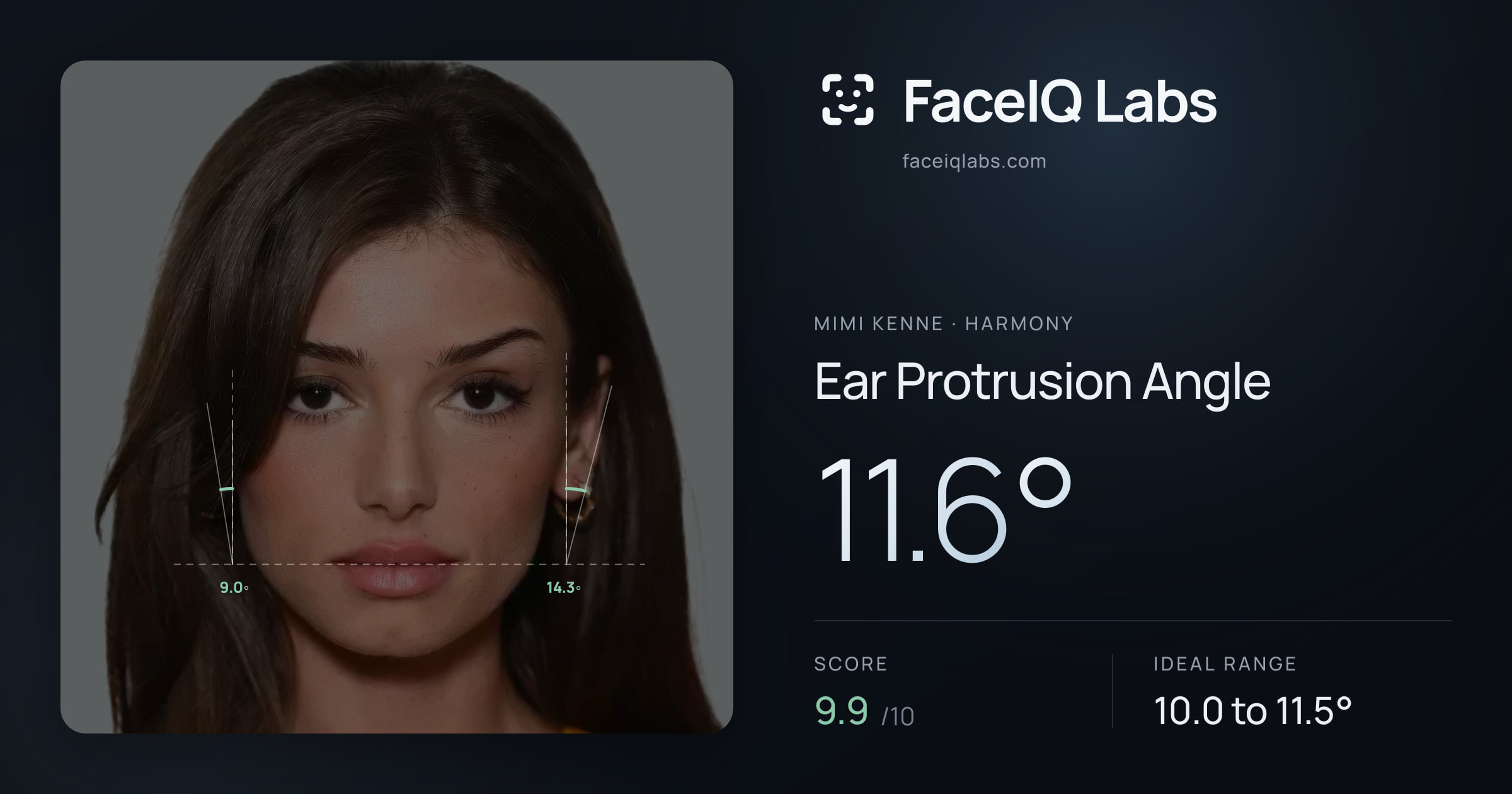 Mimi Kenne Ear Protrusion Angle: 11.6°, drawn on the photo