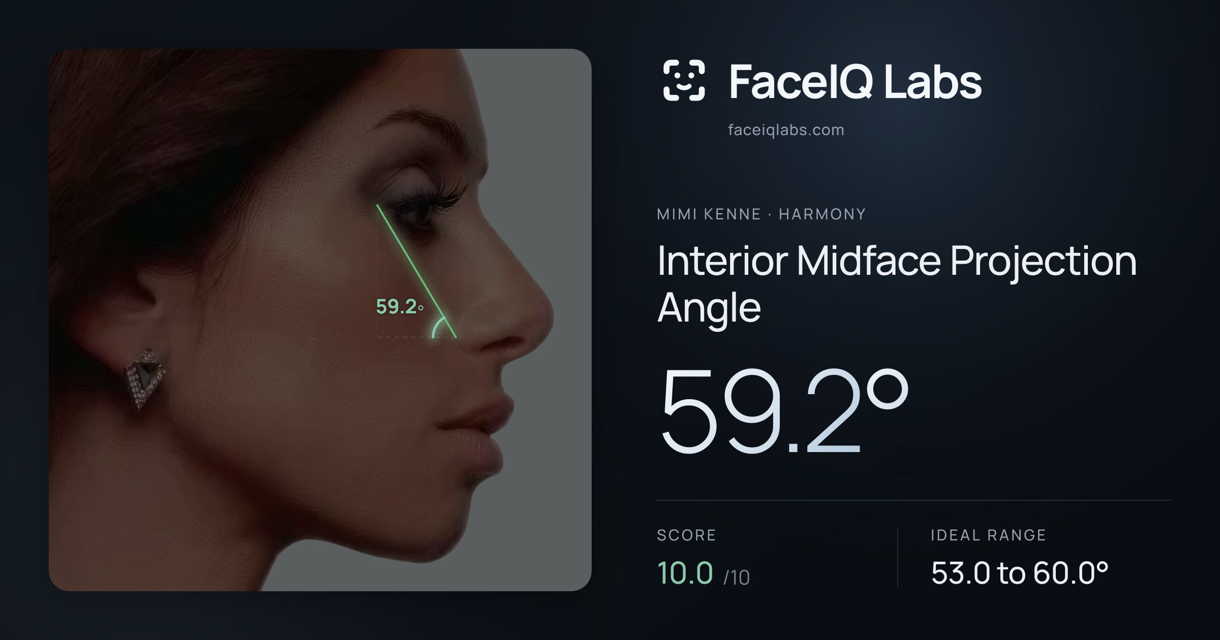 Mimi Kenne Interior Midface Projection Angle: 59.2°, drawn on the photo