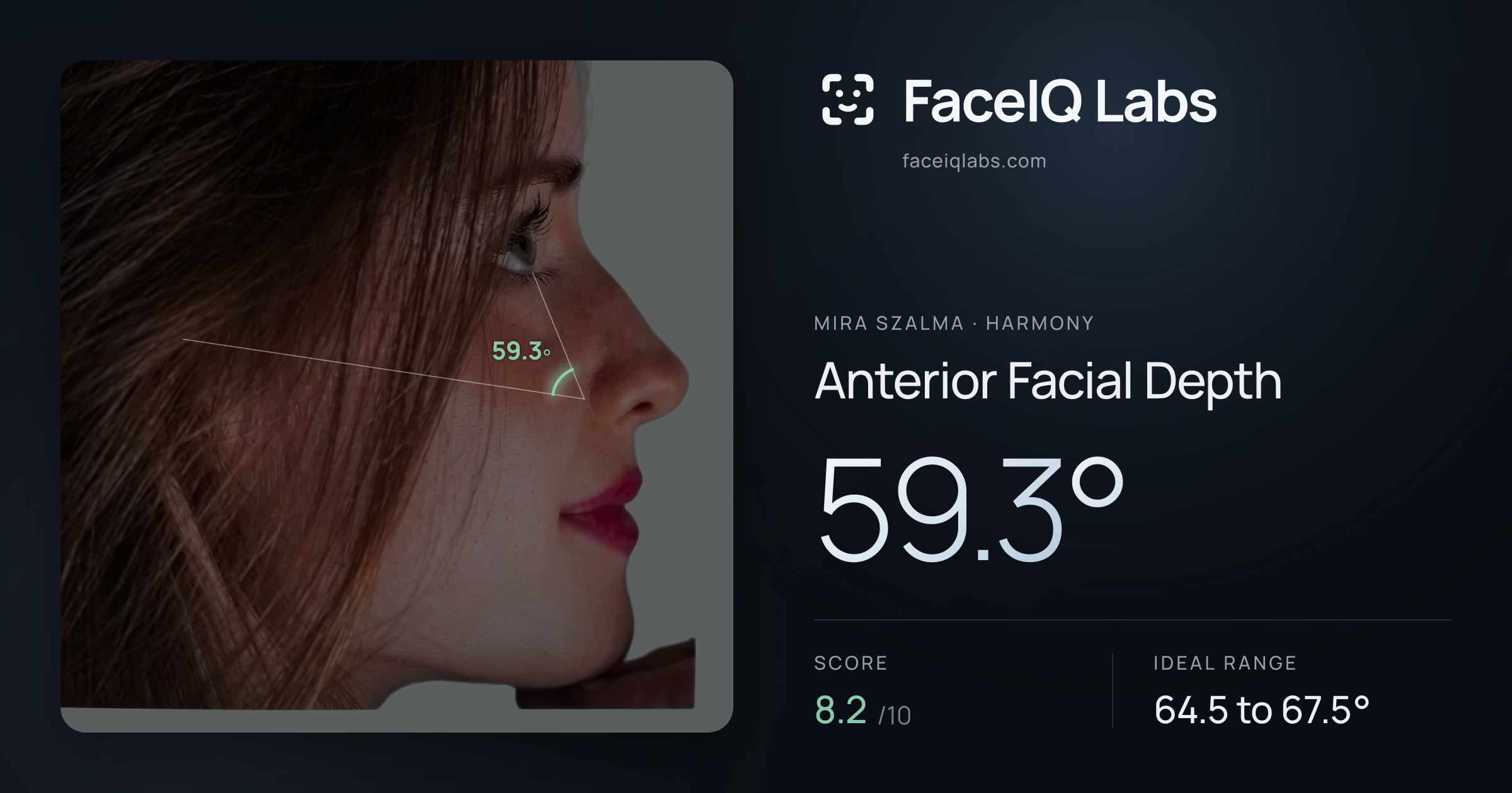 Mira Szalma Anterior Facial Depth: 59.3°, drawn on the photo