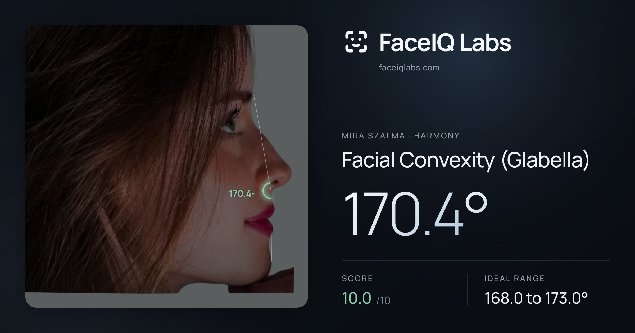 Mira Szalma Facial Convexity (Glabella): 170.4°, drawn on the photo