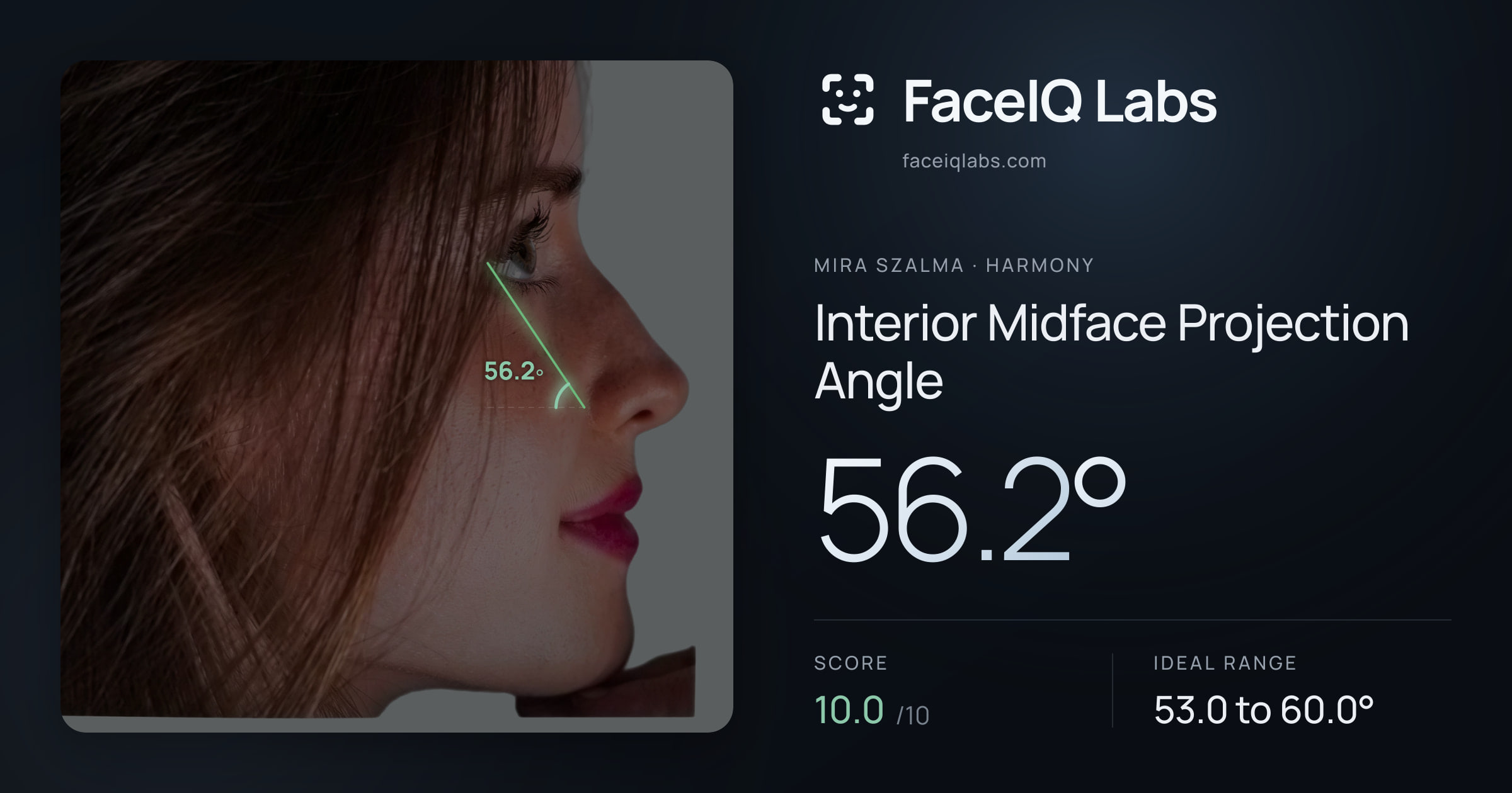Mira Szalma Interior Midface Projection Angle: 56.2°, drawn on the photo