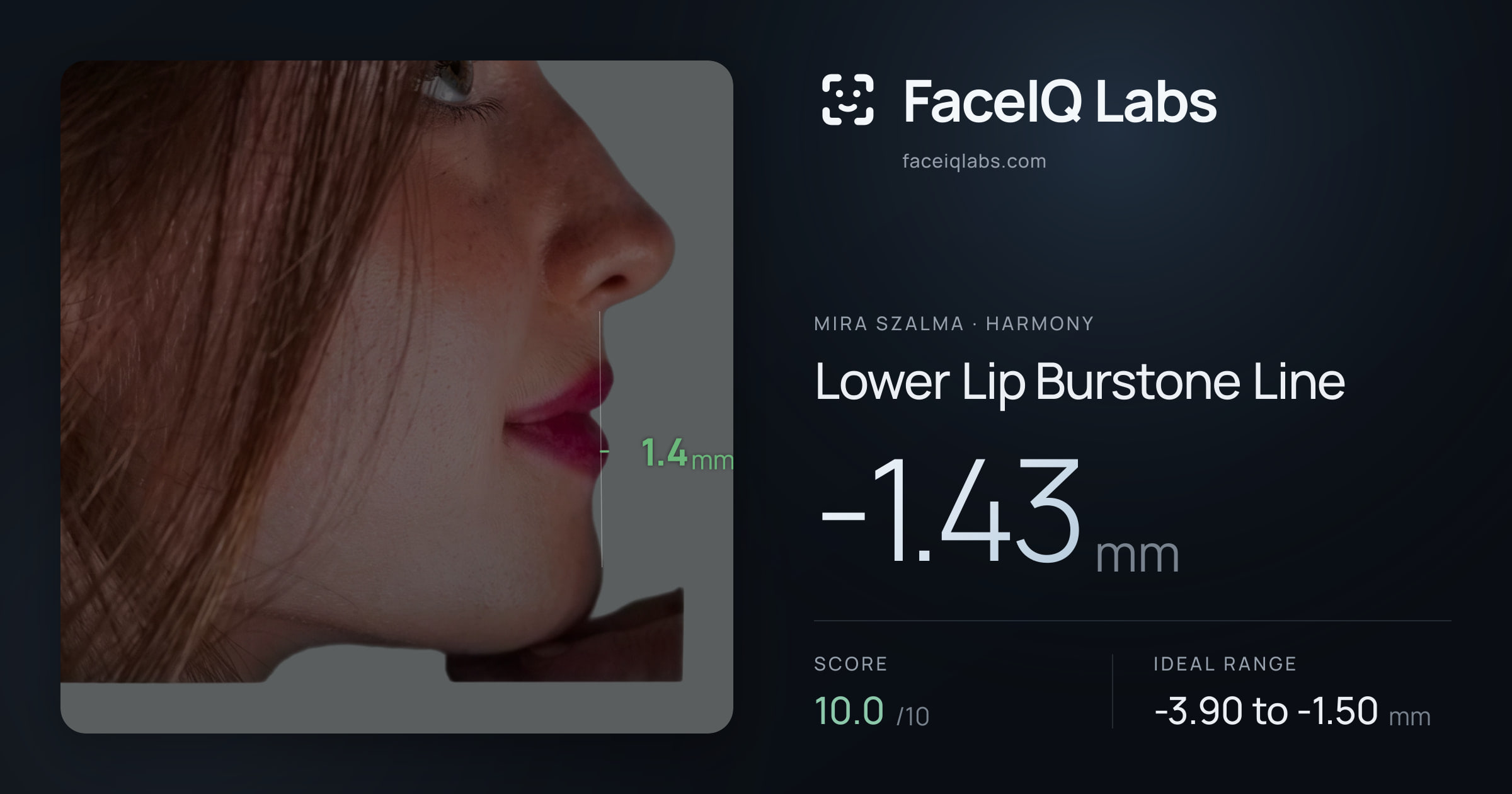 Mira Szalma Lower Lip Burstone Line: -1.43mm, drawn on the photo