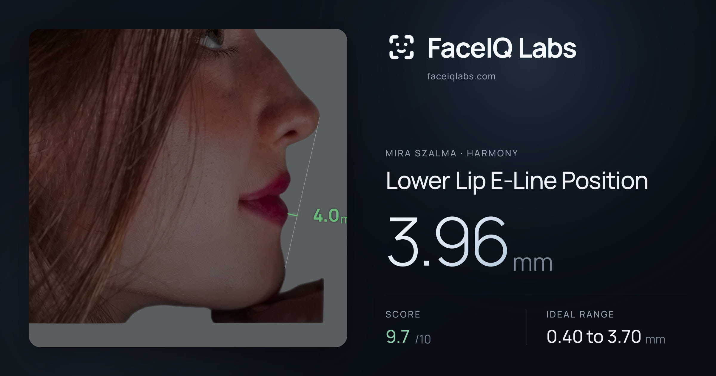 Mira Szalma Lower Lip E-Line Position: 3.96mm, drawn on the photo