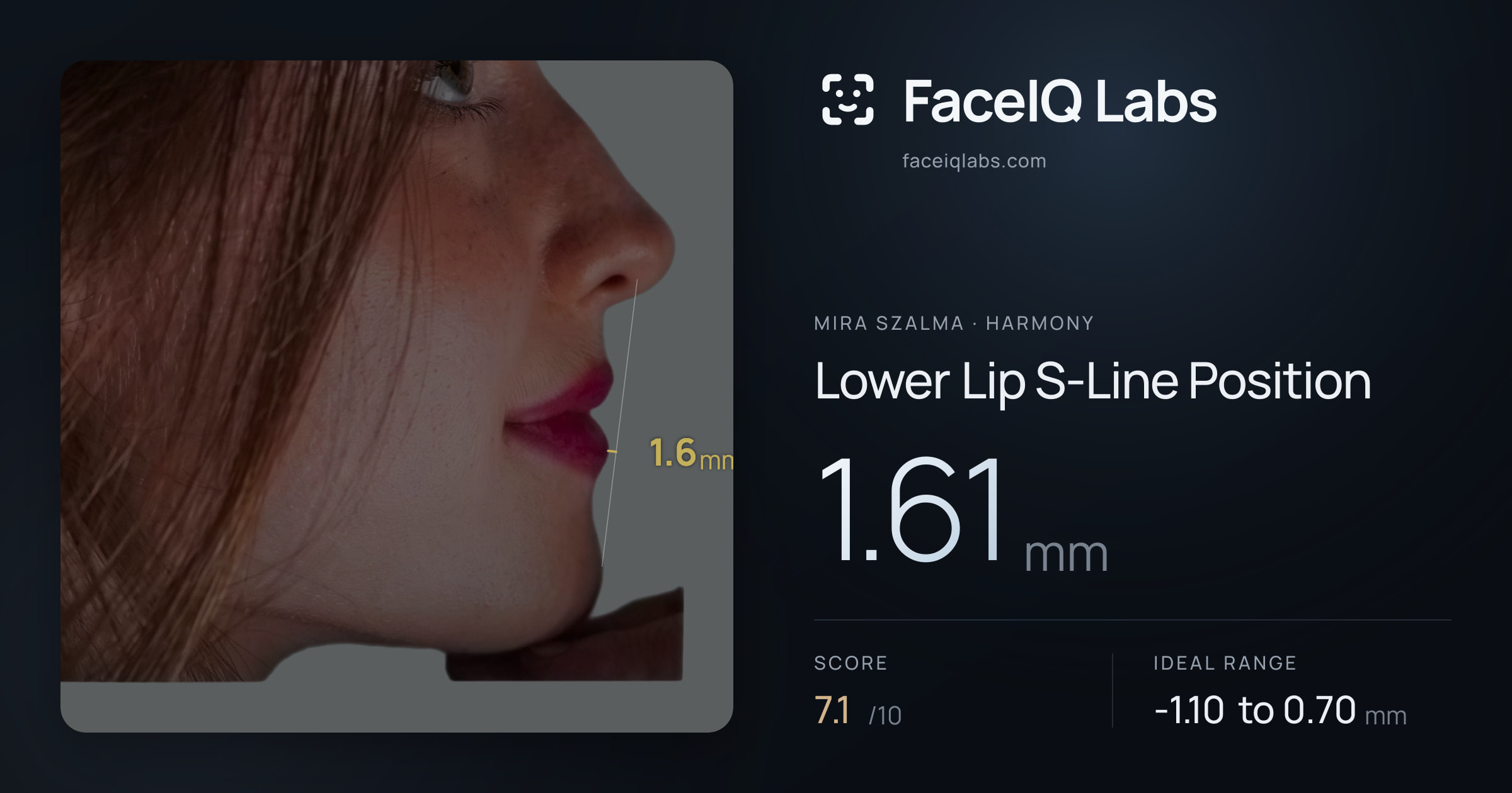 Mira Szalma Lower Lip S-Line Position: 1.61mm, drawn on the photo