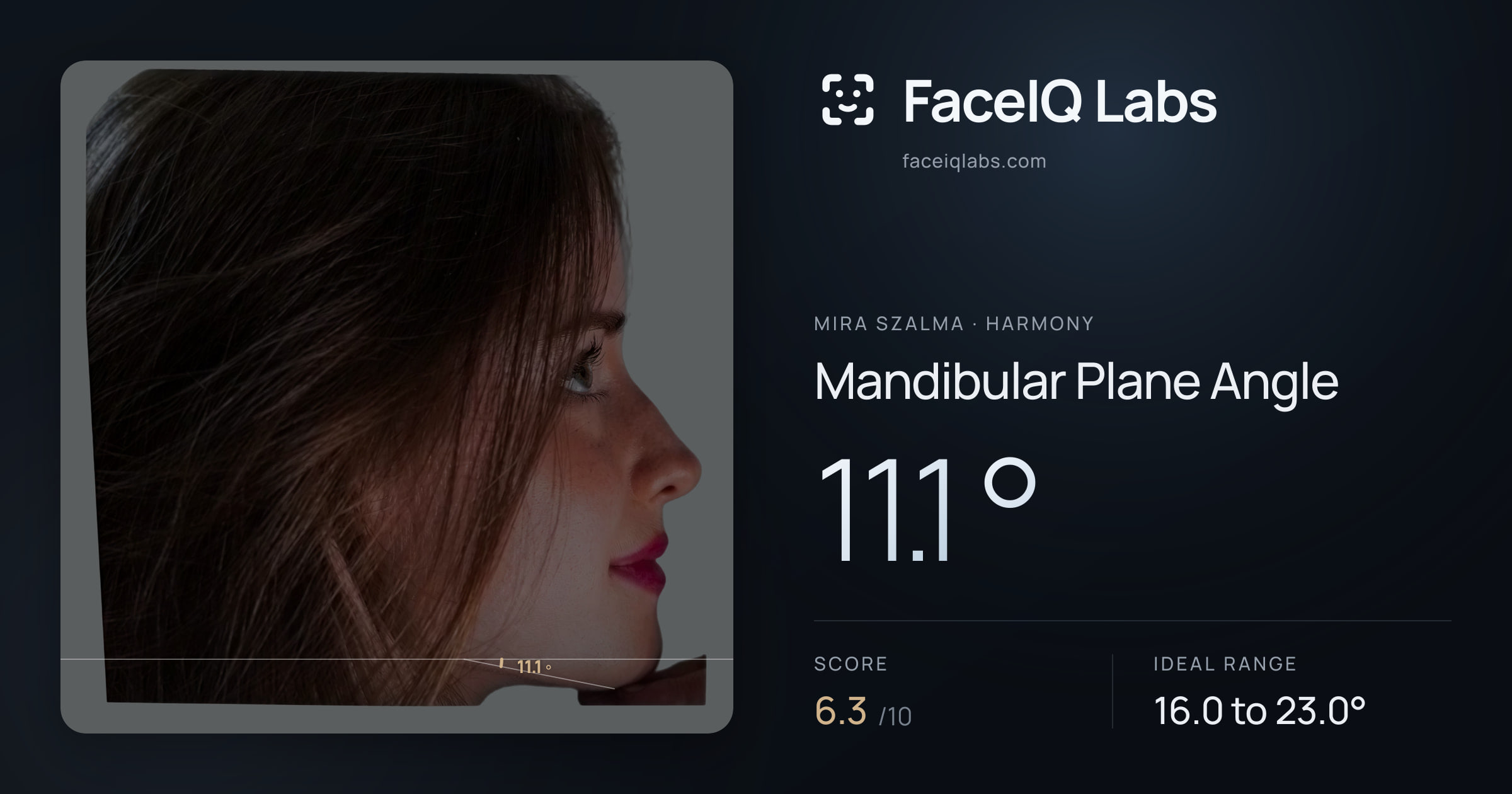 Mira Szalma Mandibular Plane Angle: 11.1°, drawn on the photo