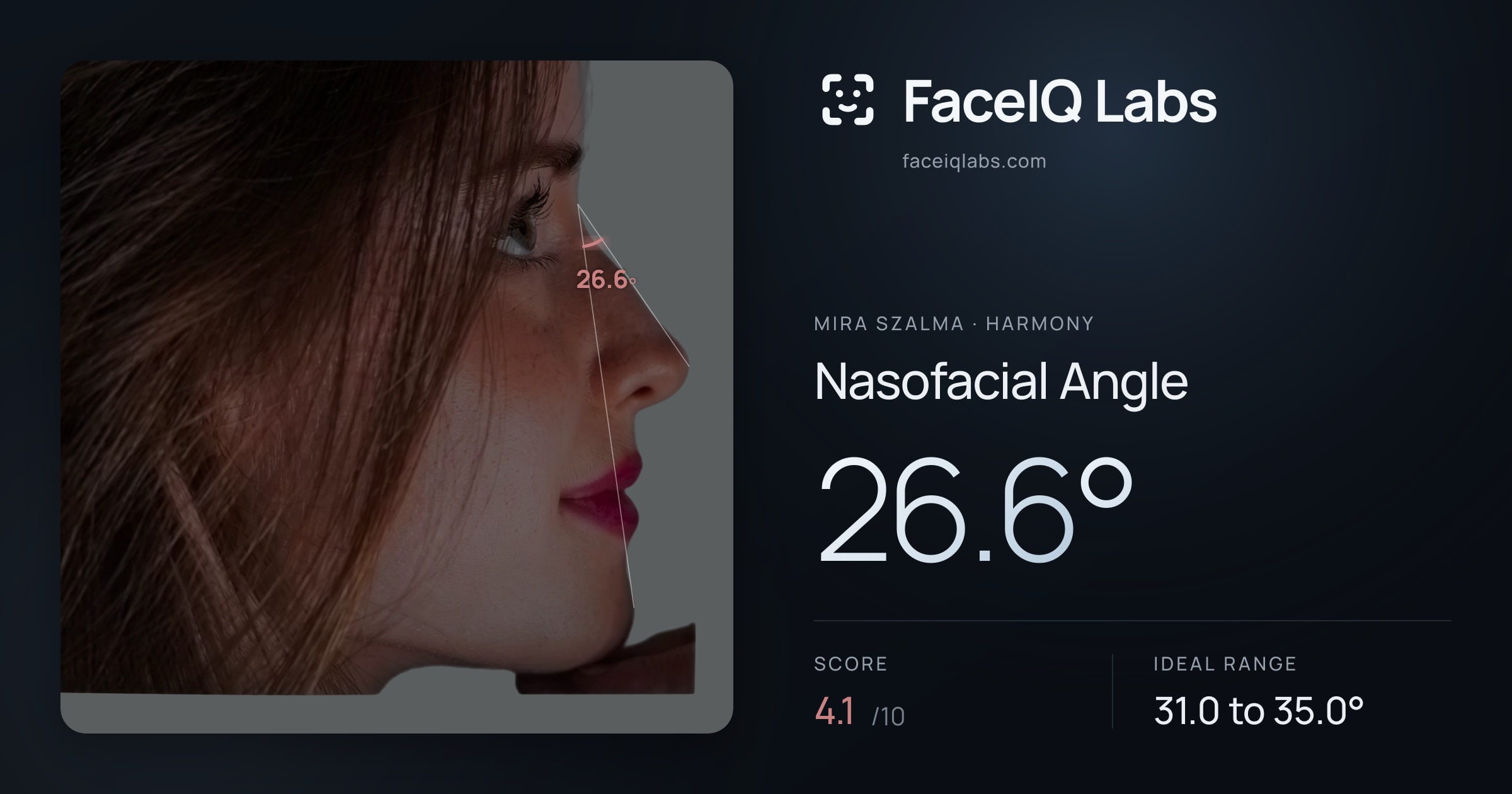 Mira Szalma Nasofacial Angle: 26.6°, drawn on the photo