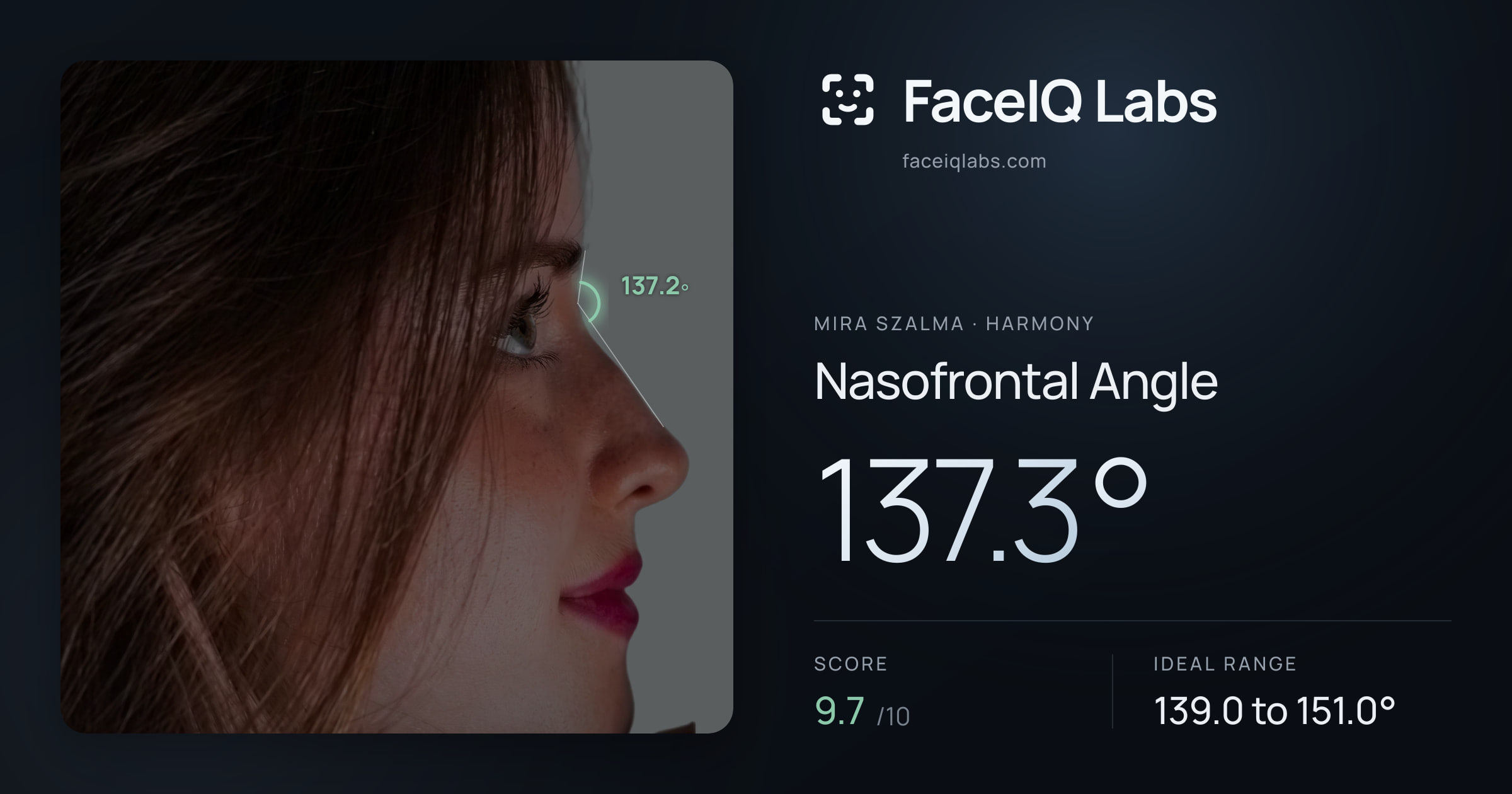 Mira Szalma Nasofrontal Angle: 137.3°, drawn on the photo