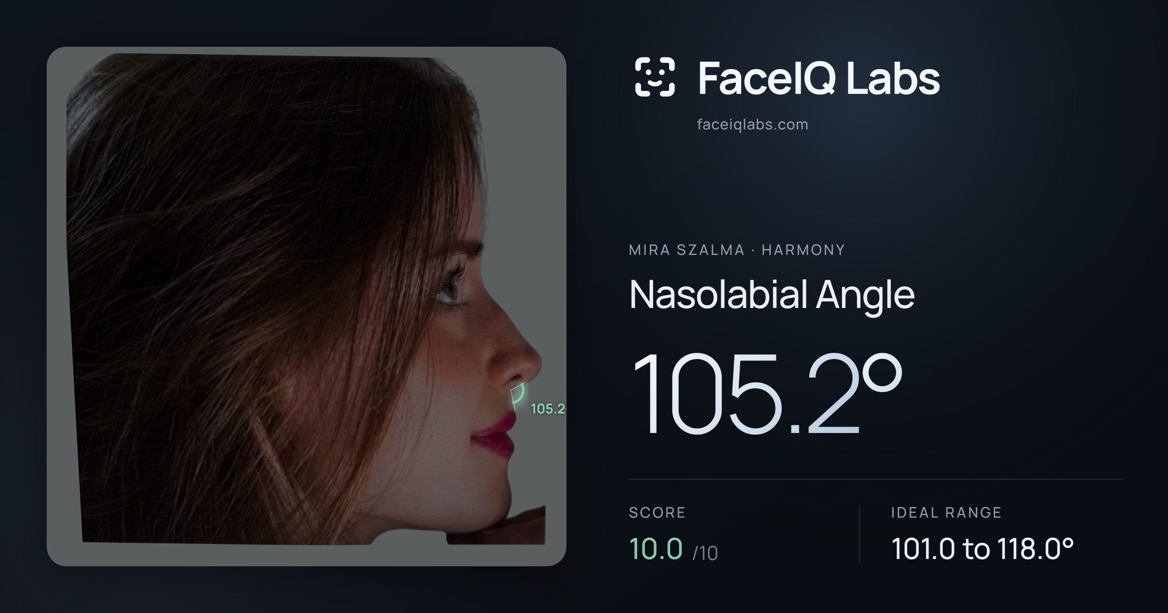 Mira Szalma Nasolabial Angle: 105.2°, drawn on the photo