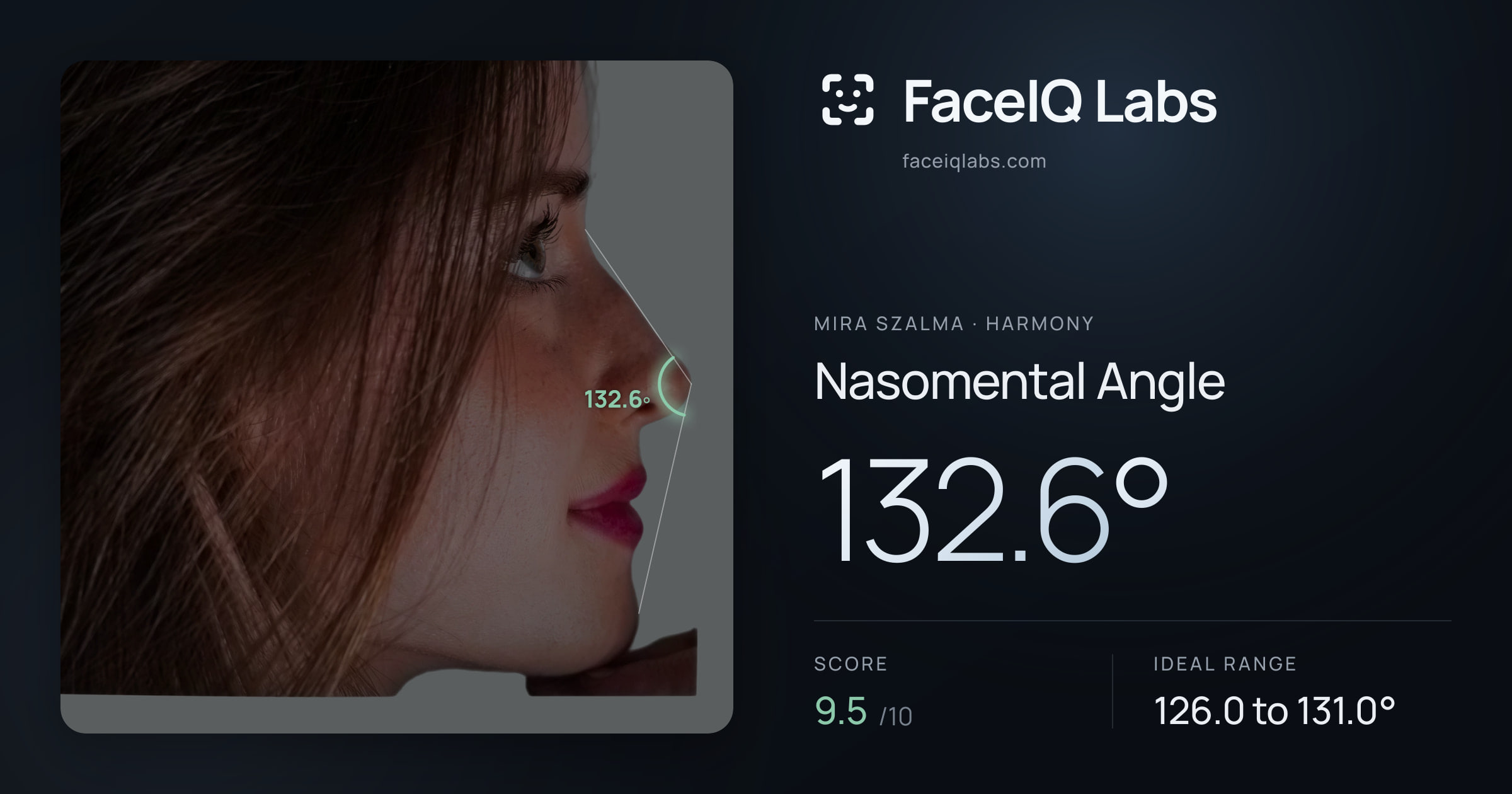 Mira Szalma Nasomental Angle: 132.6°, drawn on the photo