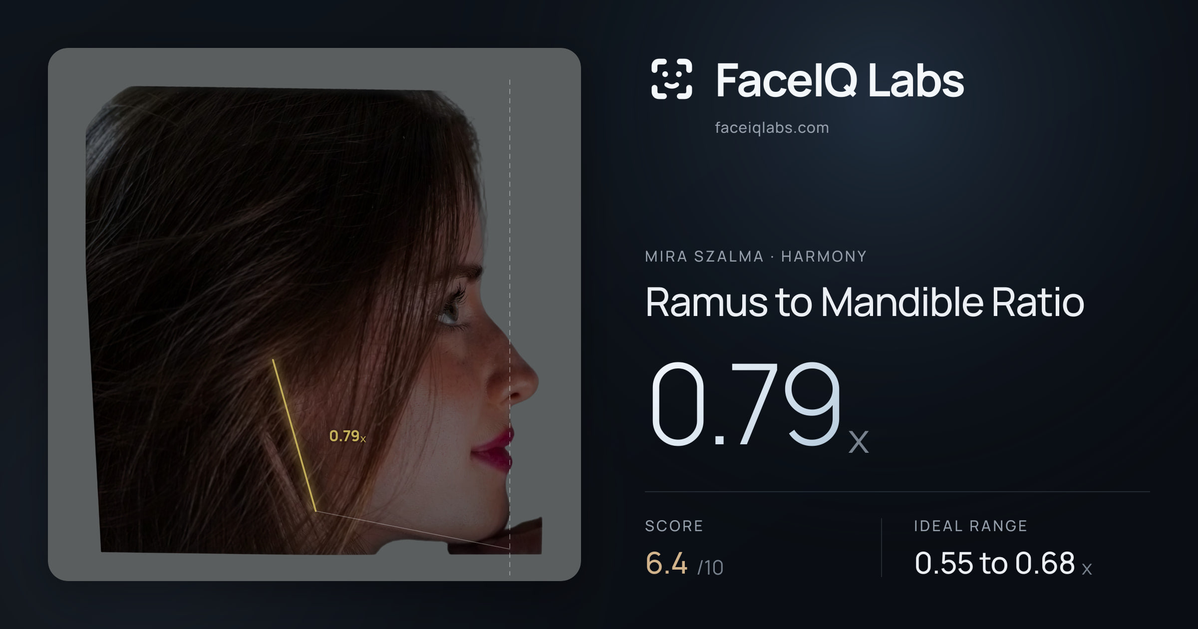 Mira Szalma Ramus to Mandible Ratio: 0.79x, drawn on the photo