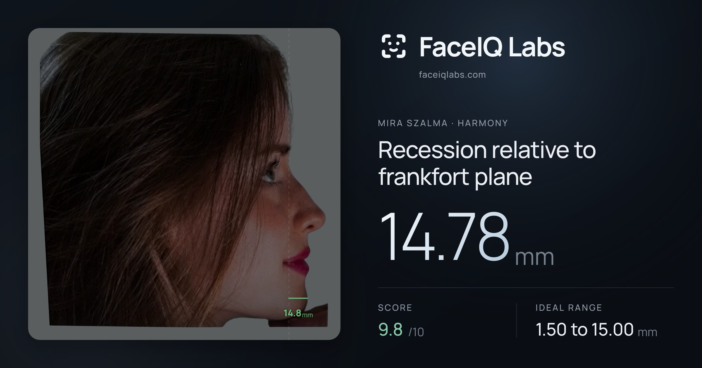Mira Szalma Recession relative to frankfort plane: 14.78mm, drawn on the photo