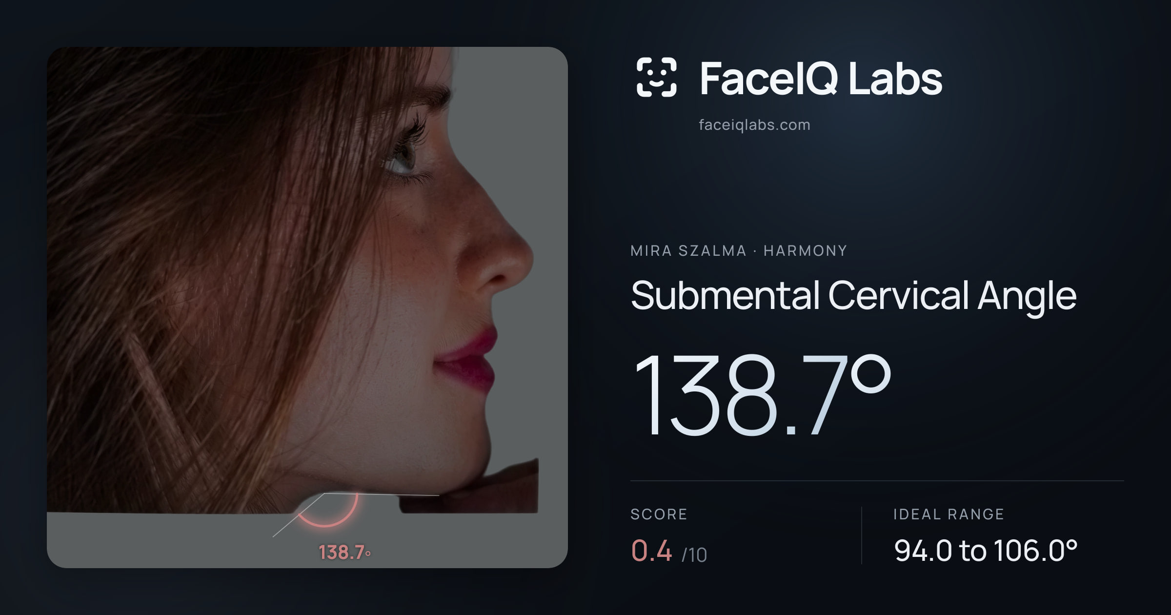 Mira Szalma Submental Cervical Angle: 138.7°, drawn on the photo