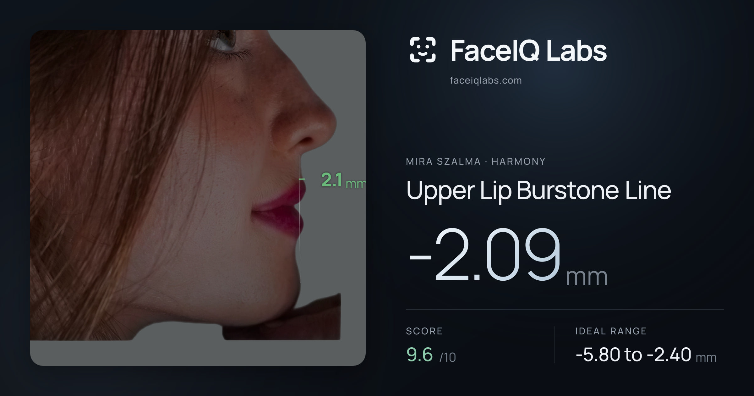 Mira Szalma Upper Lip Burstone Line: -2.09mm, drawn on the photo