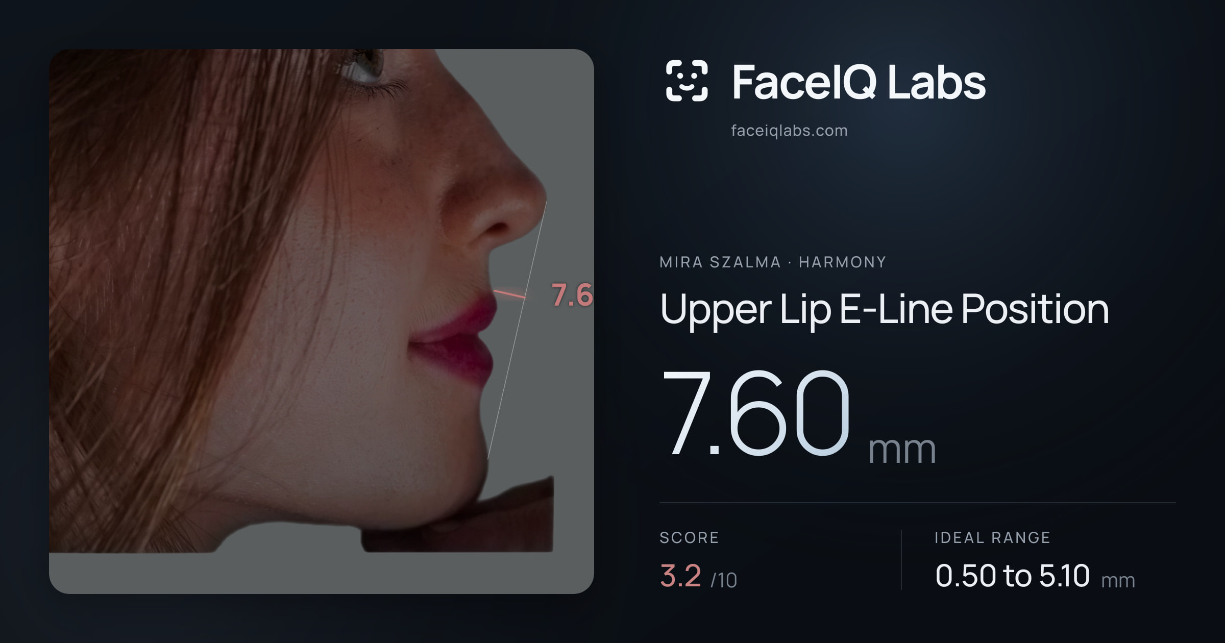 Mira Szalma Upper Lip E-Line Position: 7.60mm, drawn on the photo