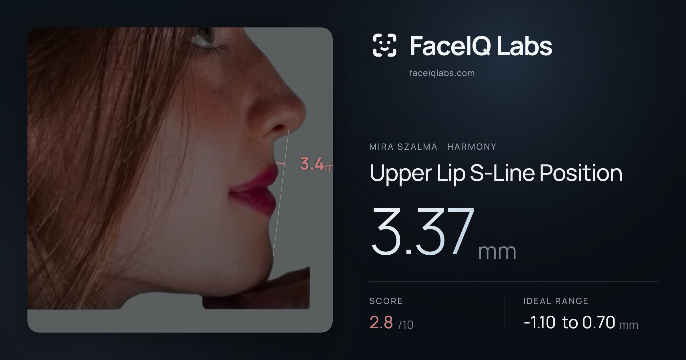 Mira Szalma Upper Lip S-Line Position: 3.37mm, drawn on the photo