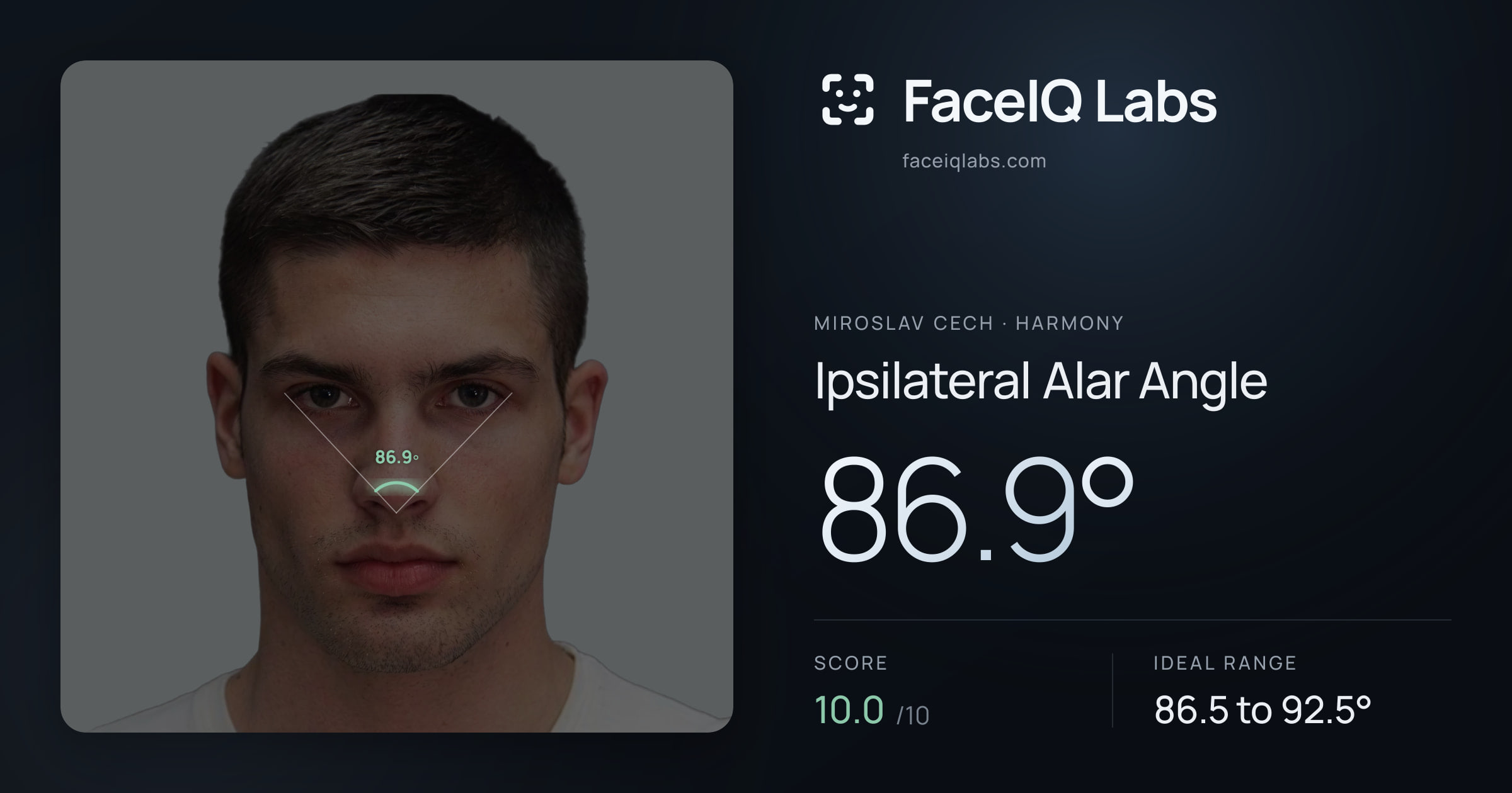 Miroslav Cech Ipsilateral Alar Angle: 86.9°, drawn on the photo