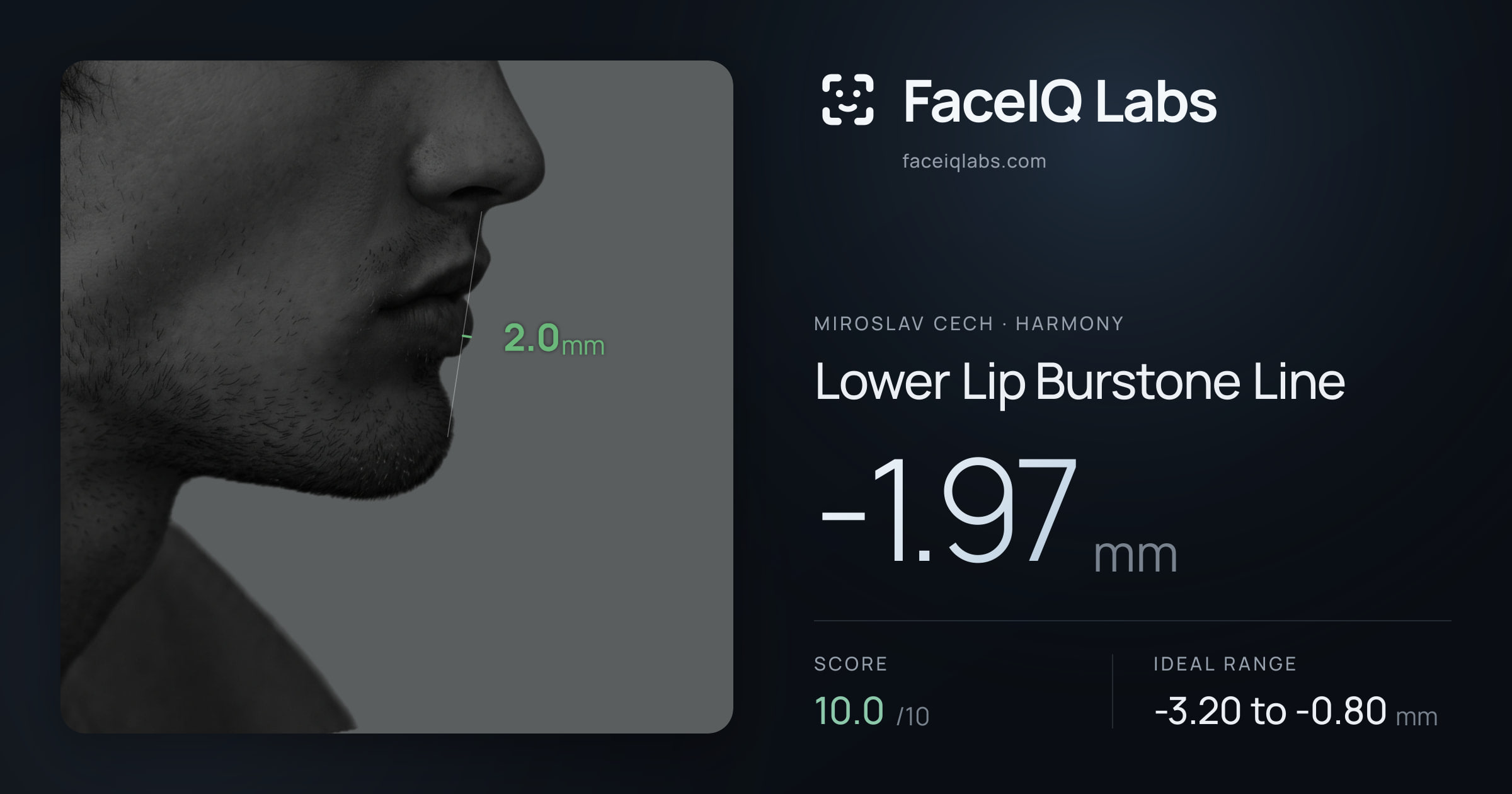 Miroslav Cech Lower Lip Burstone Line: -1.97mm, drawn on the photo