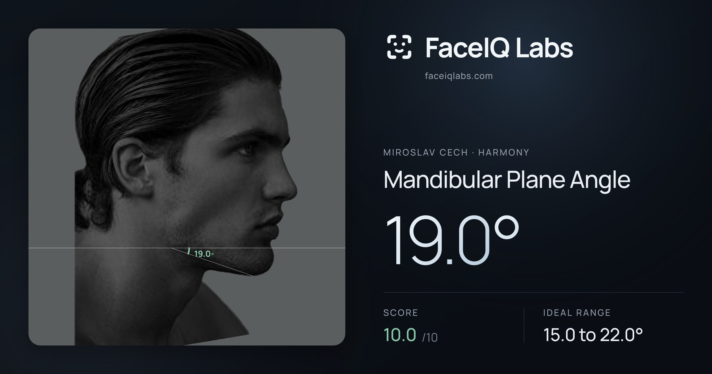 Miroslav Cech Mandibular Plane Angle: 19.0°, drawn on the photo