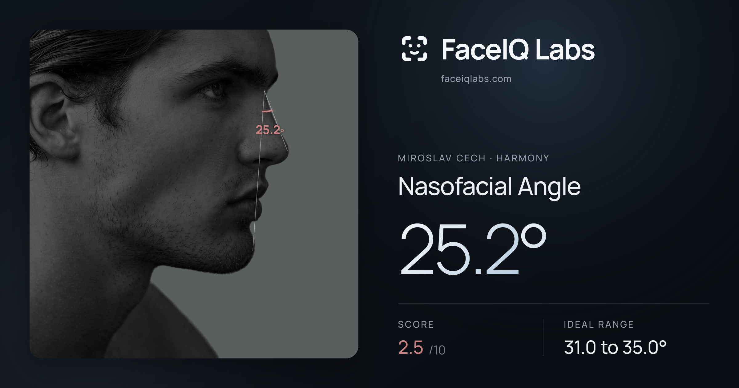 Miroslav Cech Nasofacial Angle: 25.2°, drawn on the photo