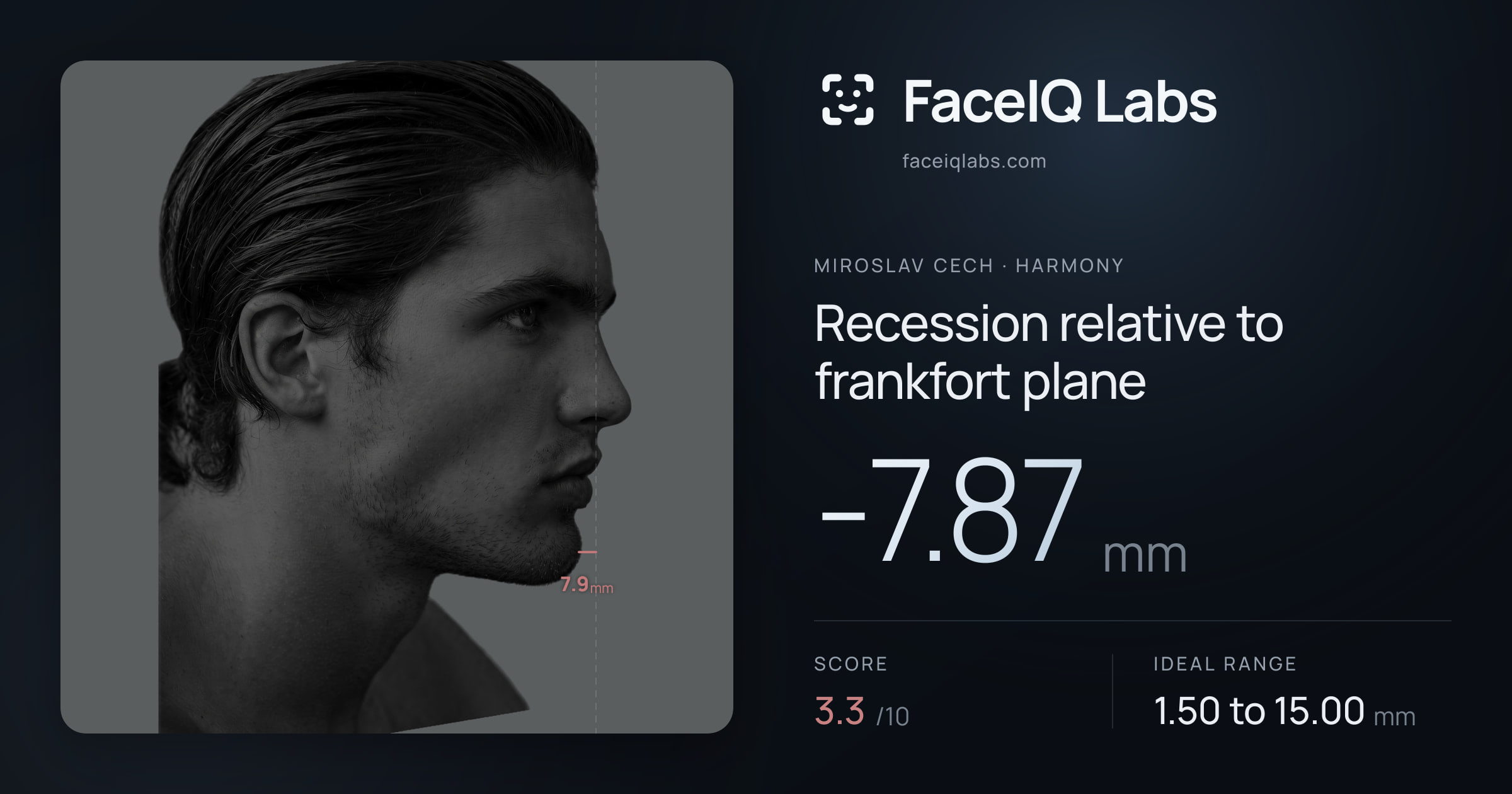 Miroslav Cech Recession relative to frankfort plane: -7.87mm, drawn on the photo