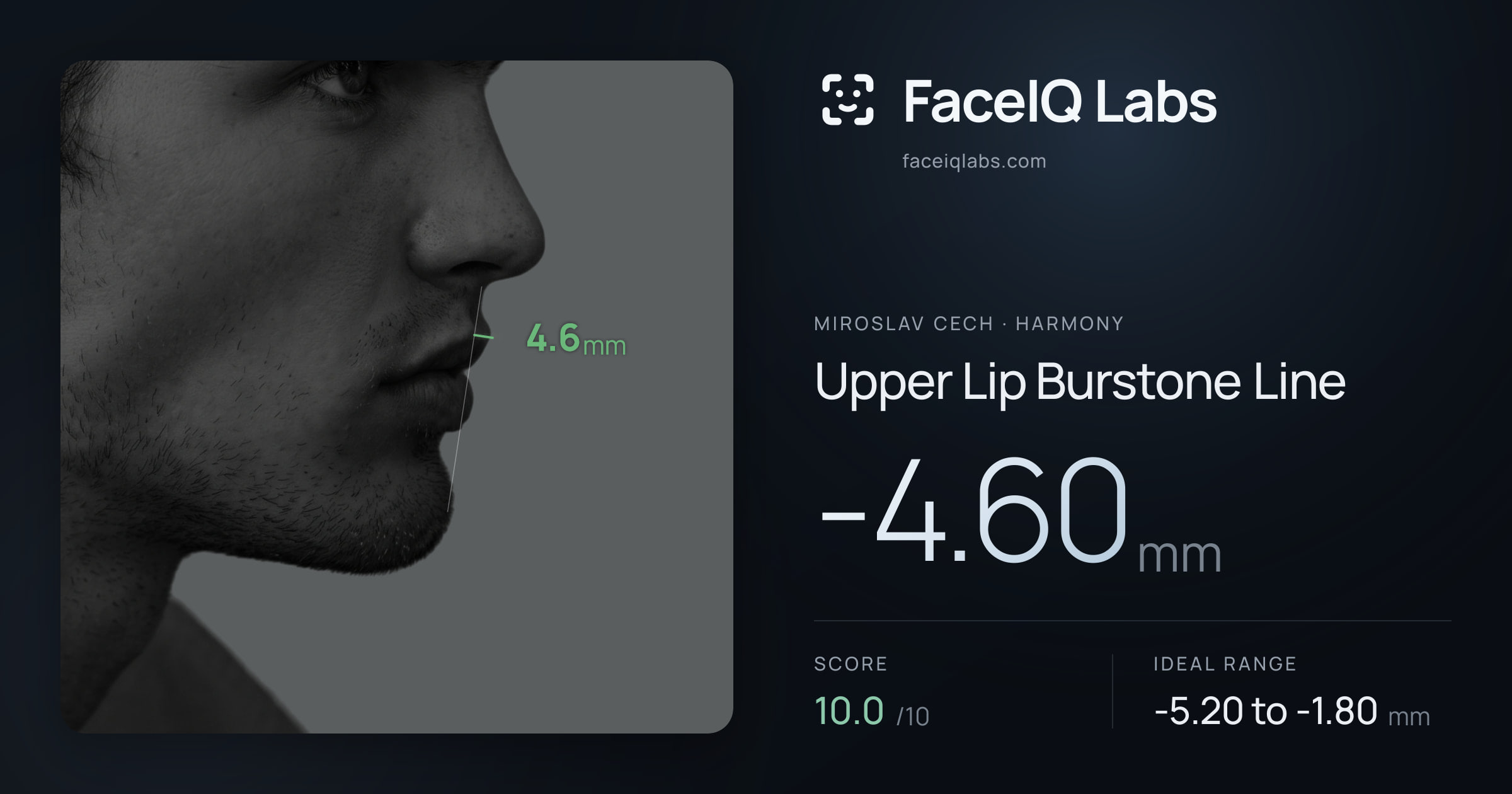 Miroslav Cech Upper Lip Burstone Line: -4.60mm, drawn on the photo