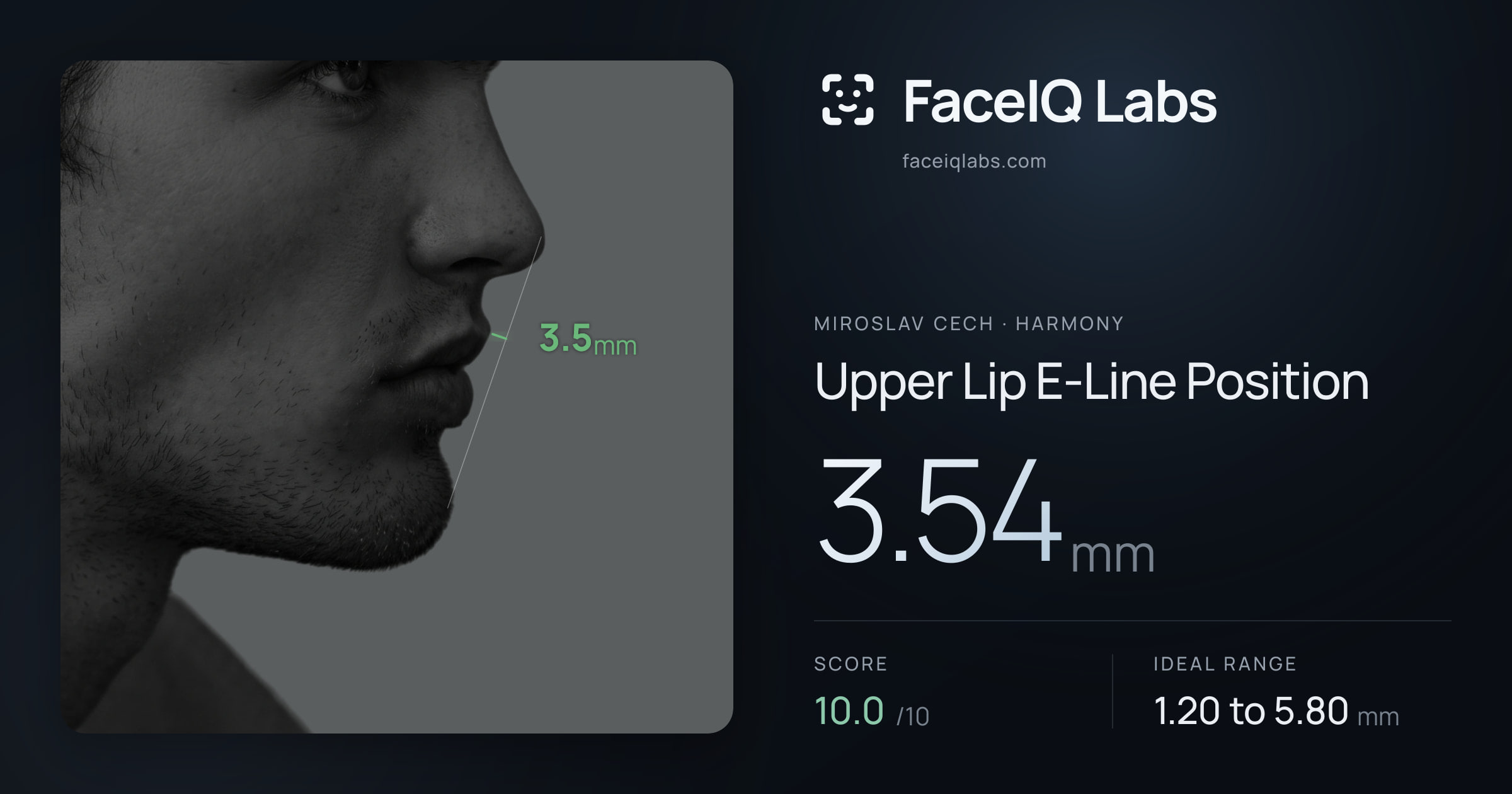 Miroslav Cech Upper Lip E-Line Position: 3.54mm, drawn on the photo