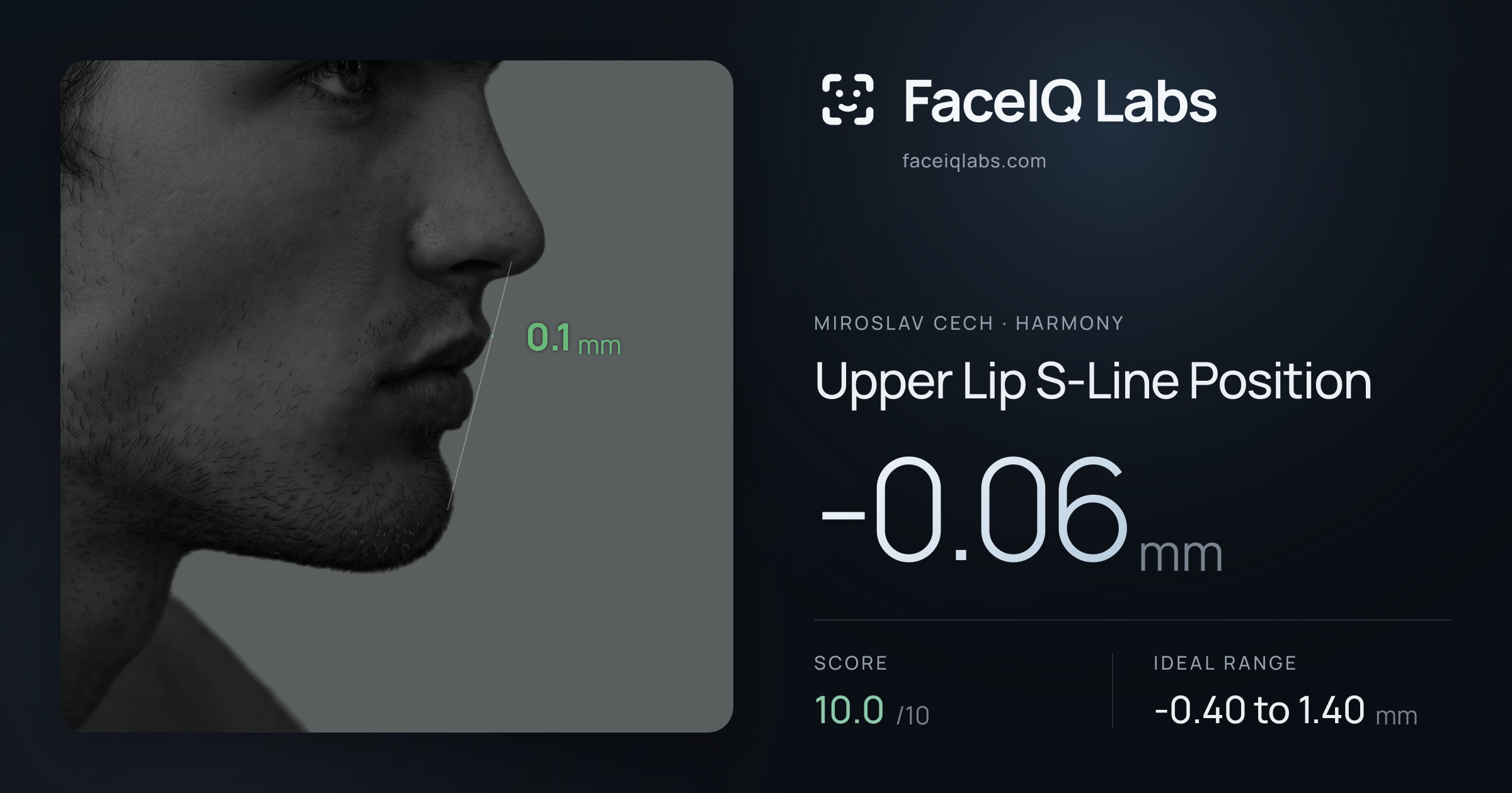 Miroslav Cech Upper Lip S-Line Position: -0.06mm, drawn on the photo