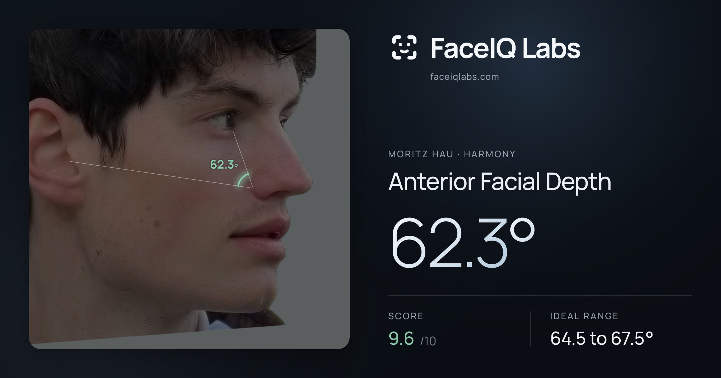 Moritz Hau Anterior Facial Depth: 62.3°, drawn on the photo