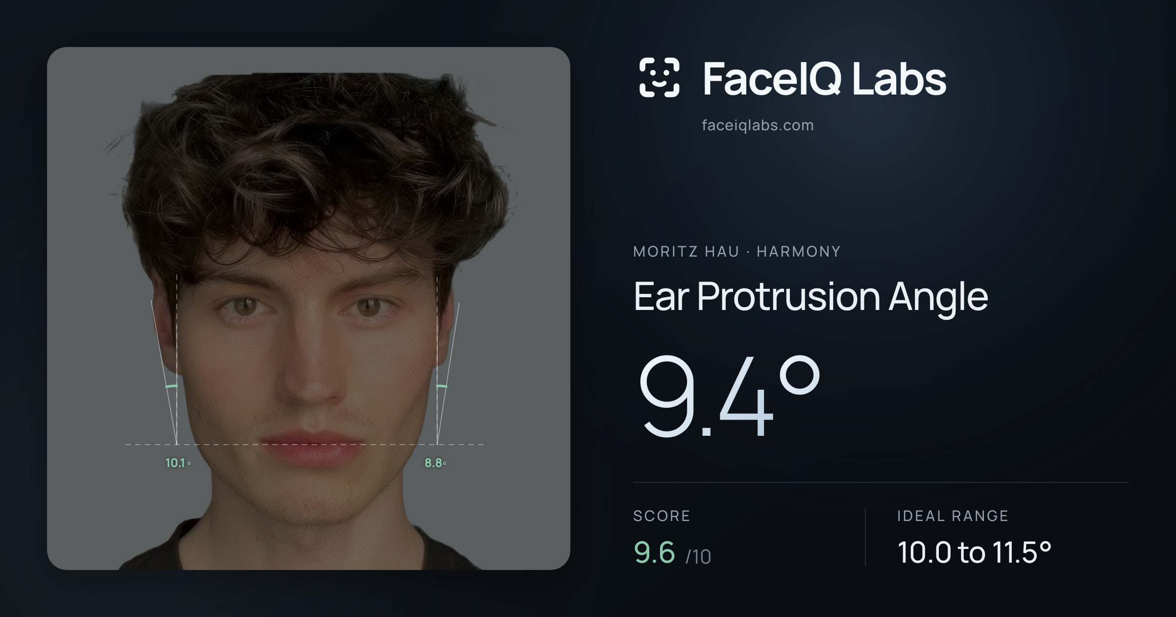 Moritz Hau Ear Protrusion Angle: 9.4°, drawn on the photo