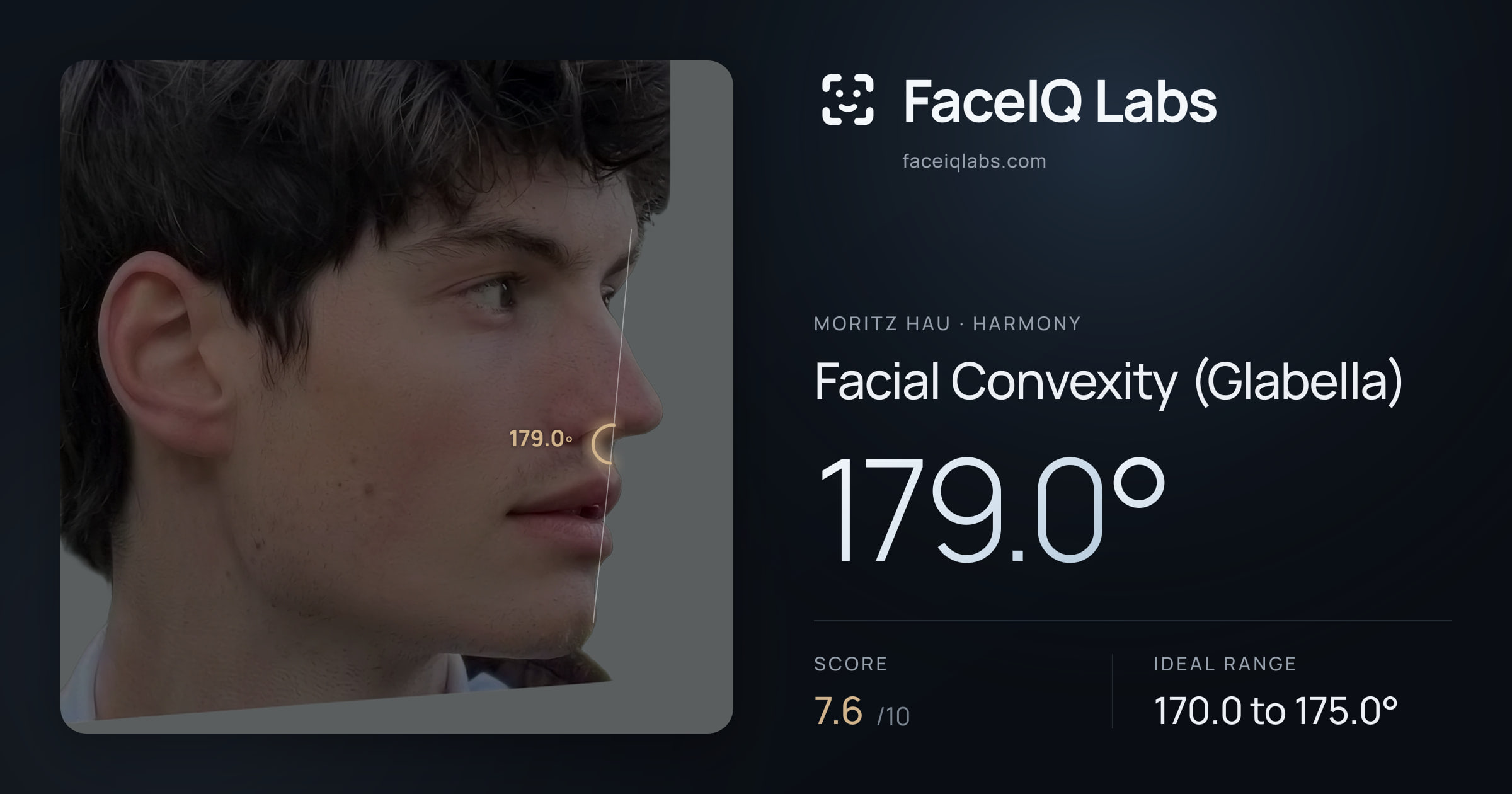 Moritz Hau Facial Convexity (Glabella): 179.0°, drawn on the photo