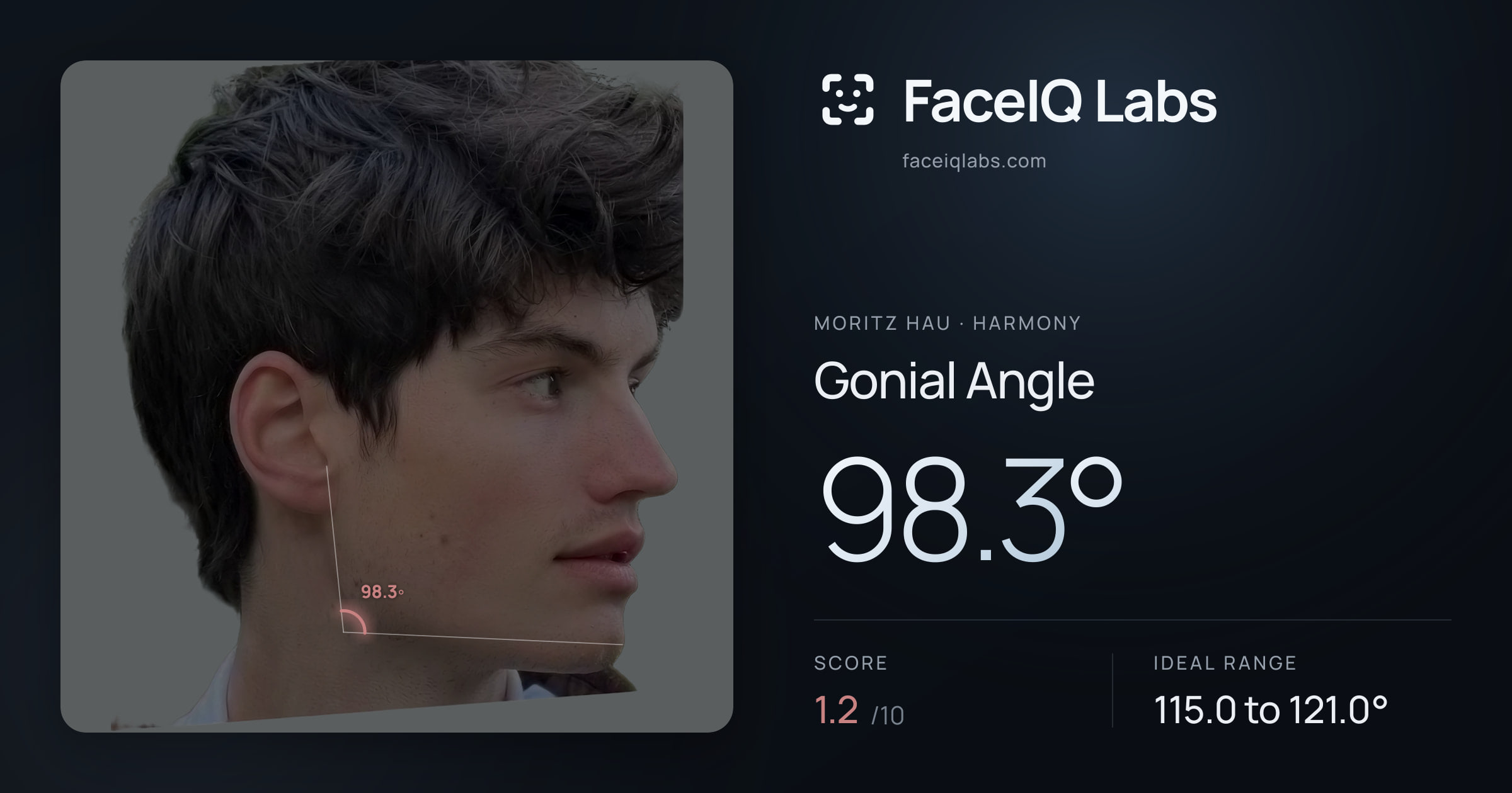 Moritz Hau Gonial Angle: 98.3°, drawn on the photo