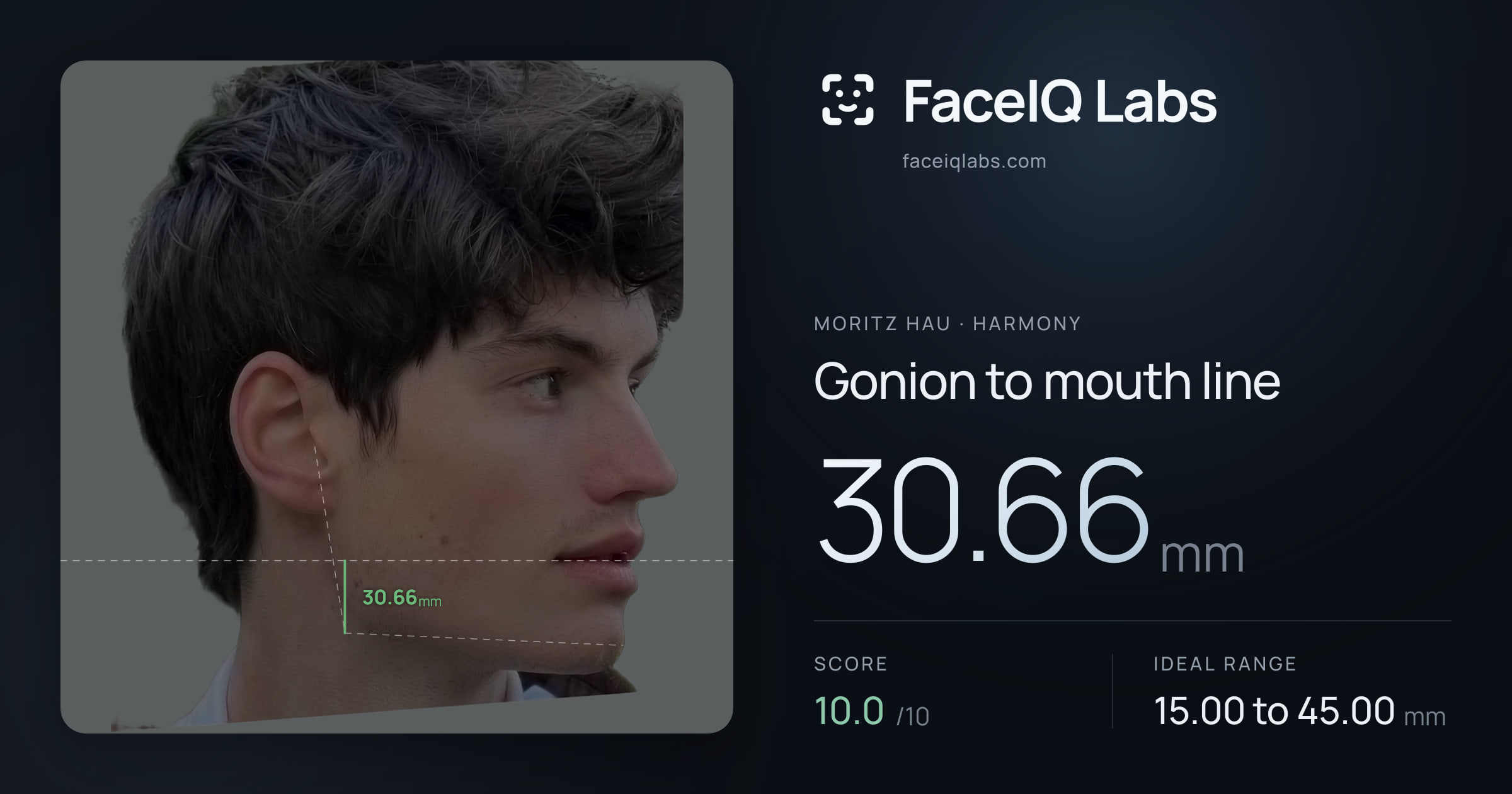 Moritz Hau Gonion to mouth line: 30.66mm, drawn on the photo