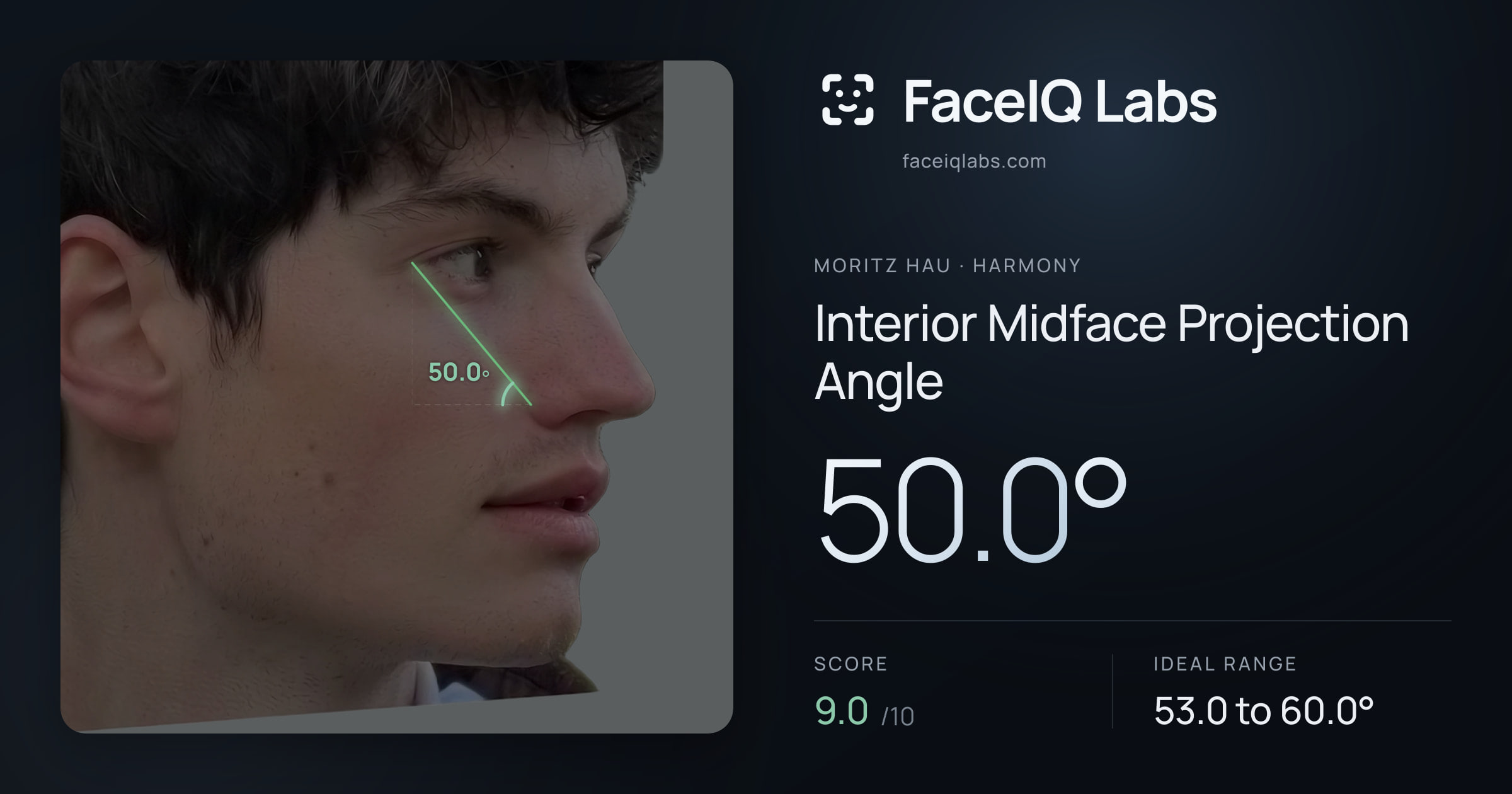 Moritz Hau Interior Midface Projection Angle: 50.0°, drawn on the photo