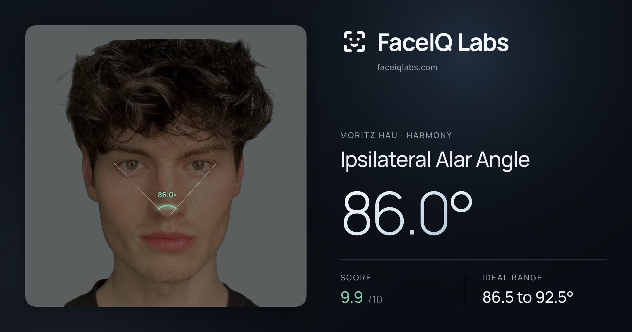 Moritz Hau Ipsilateral Alar Angle: 86.0°, drawn on the photo